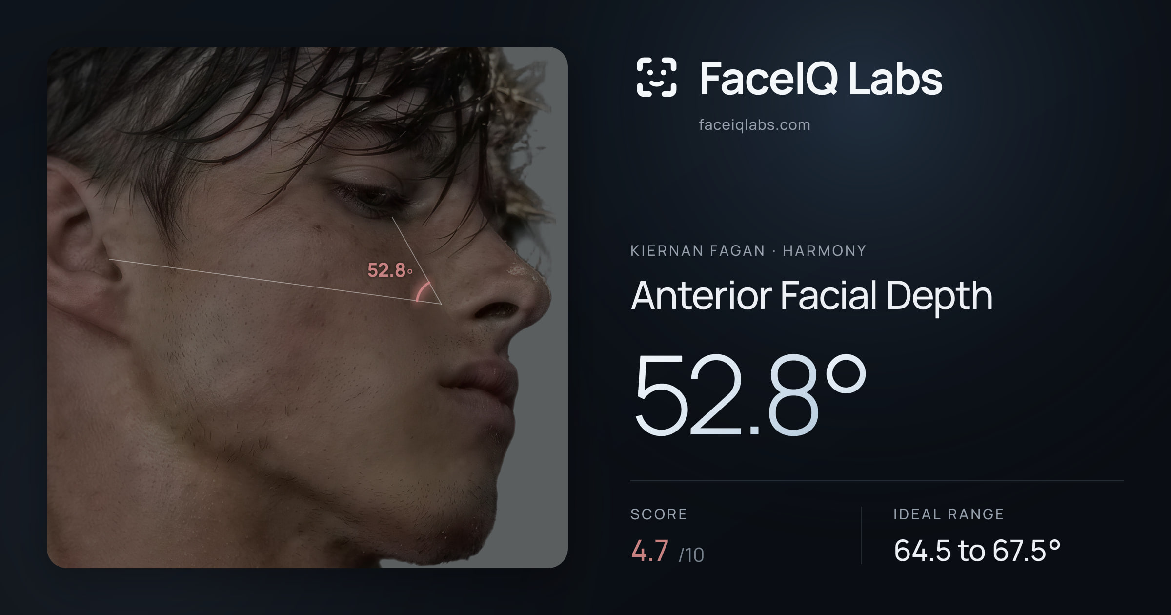 Kiernan Fagan Anterior Facial Depth: 52.8°, drawn on the photo