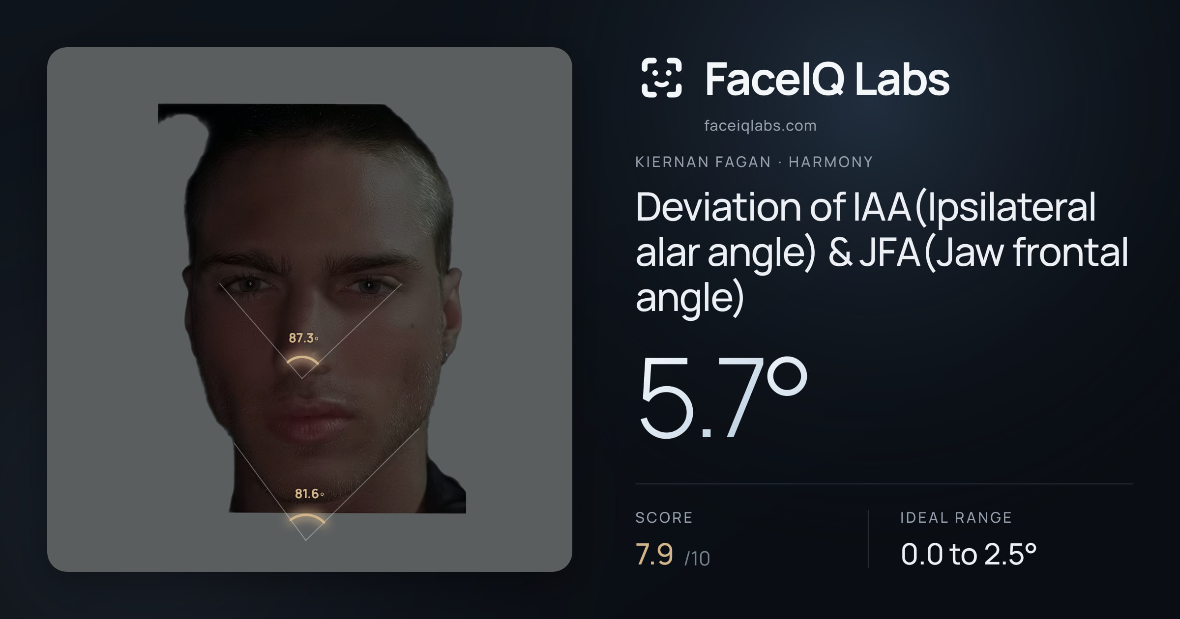 Kiernan Fagan Deviation of IAA(Ipsilateral alar angle) & JFA(Jaw frontal angle): 5.7°, drawn on the photo