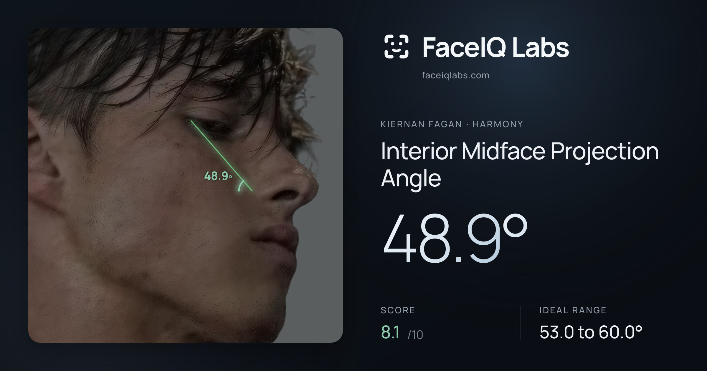 Kiernan Fagan Interior Midface Projection Angle: 48.9°, drawn on the photo