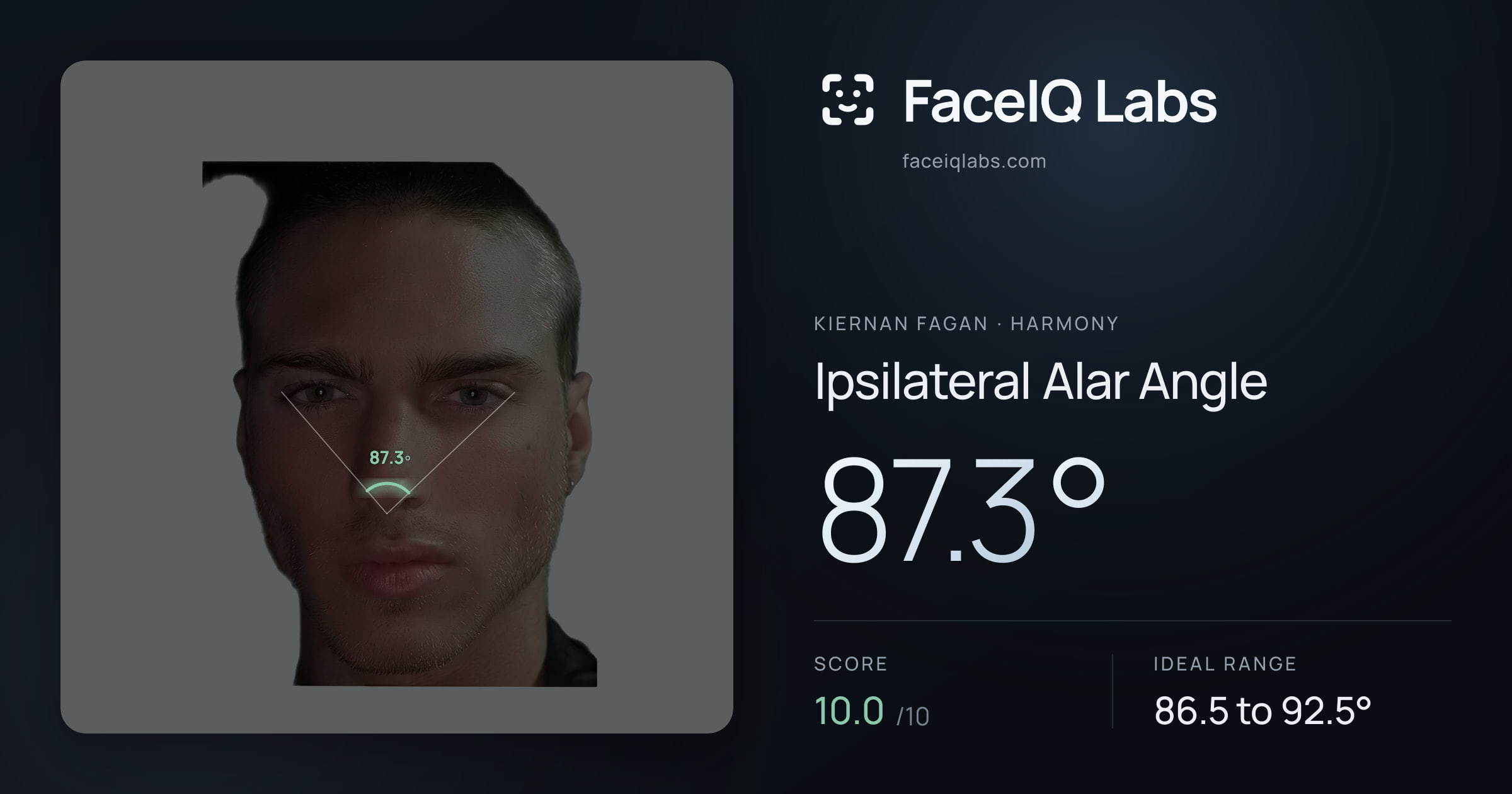 Kiernan Fagan Ipsilateral Alar Angle: 87.3°, drawn on the photo