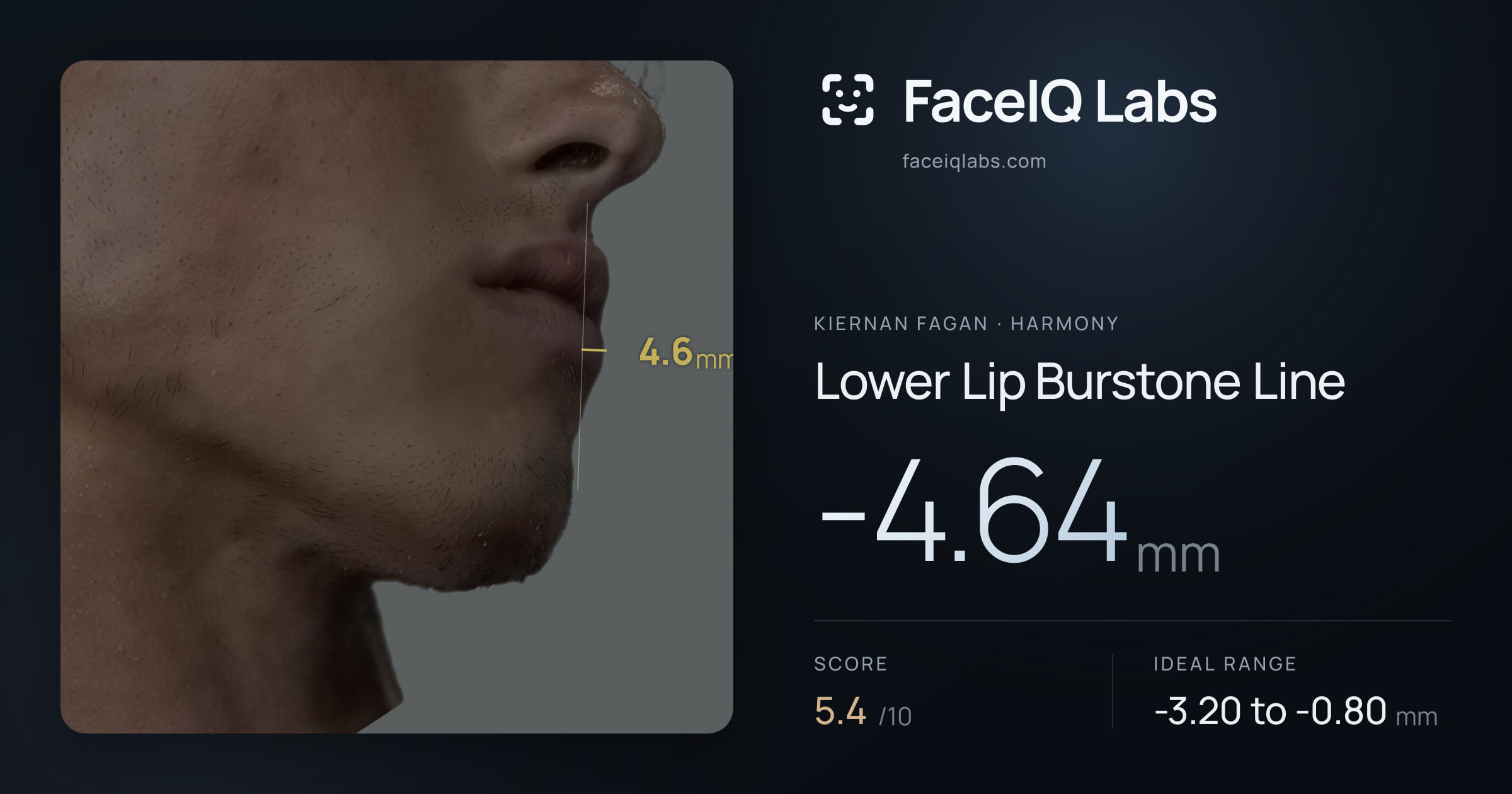 Kiernan Fagan Lower Lip Burstone Line: -4.64mm, drawn on the photo