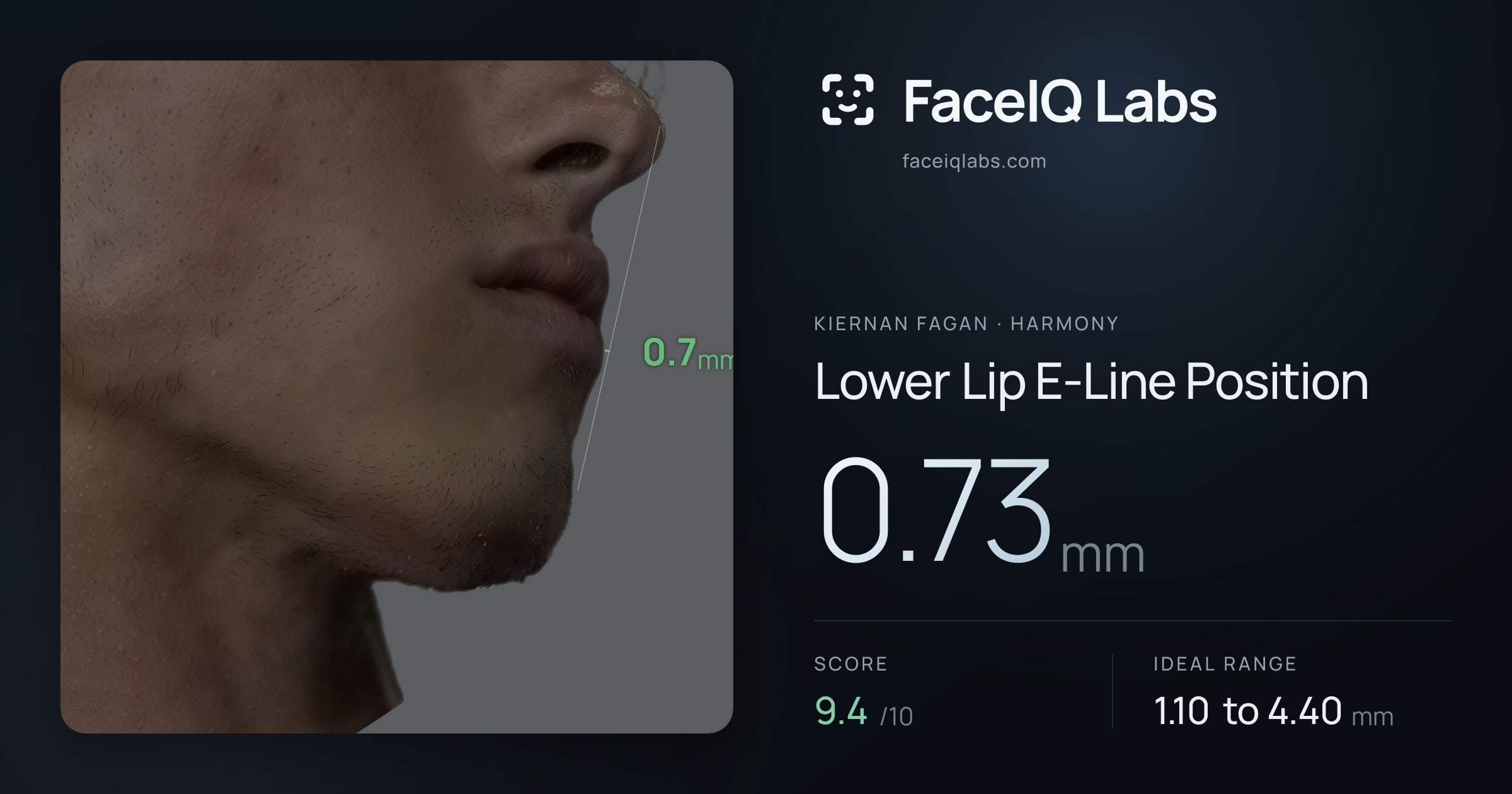 Kiernan Fagan Lower Lip E-Line Position: 0.73mm, drawn on the photo