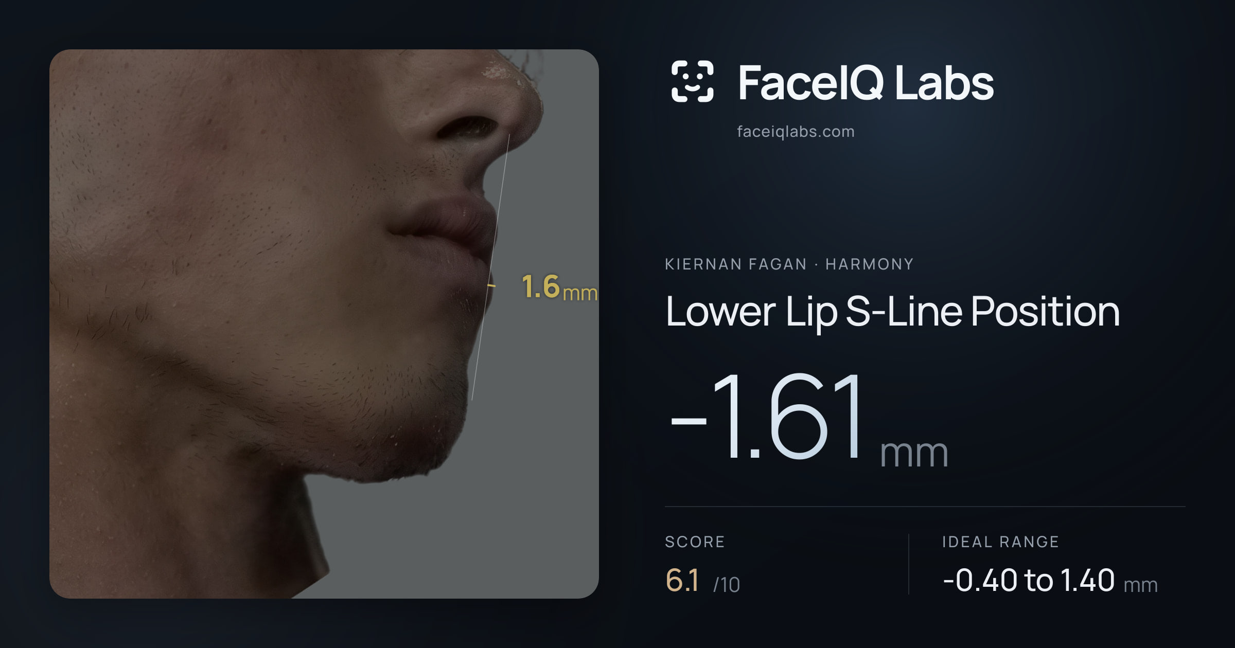 Kiernan Fagan Lower Lip S-Line Position: -1.61mm, drawn on the photo
