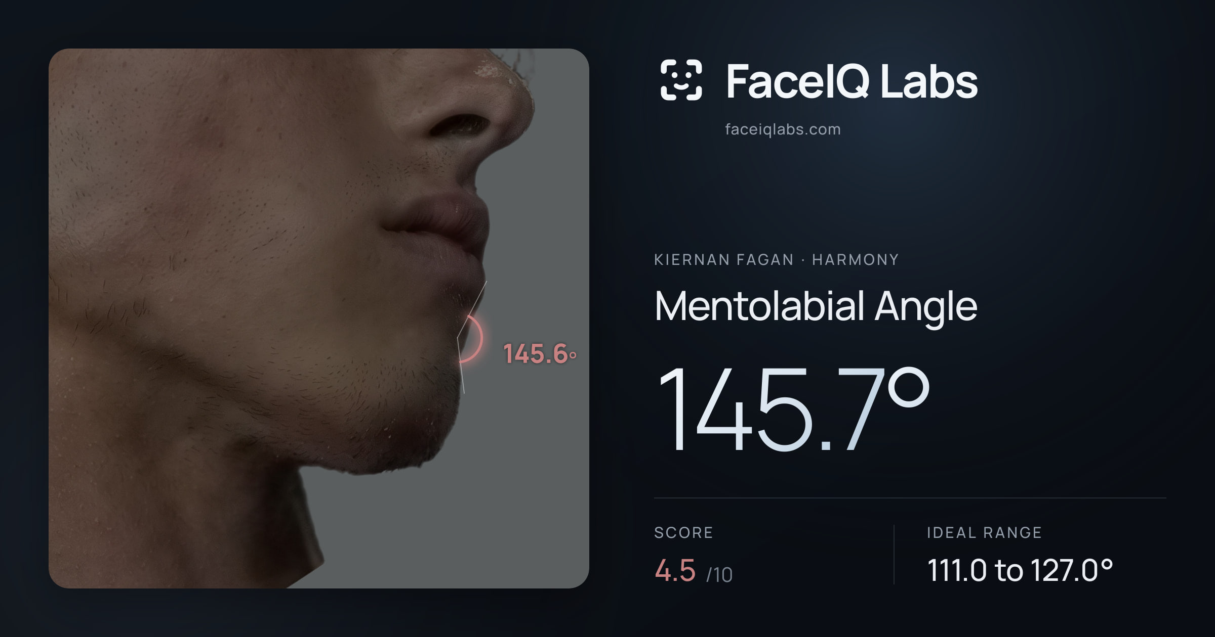 Kiernan Fagan Mentolabial Angle: 145.7°, drawn on the photo