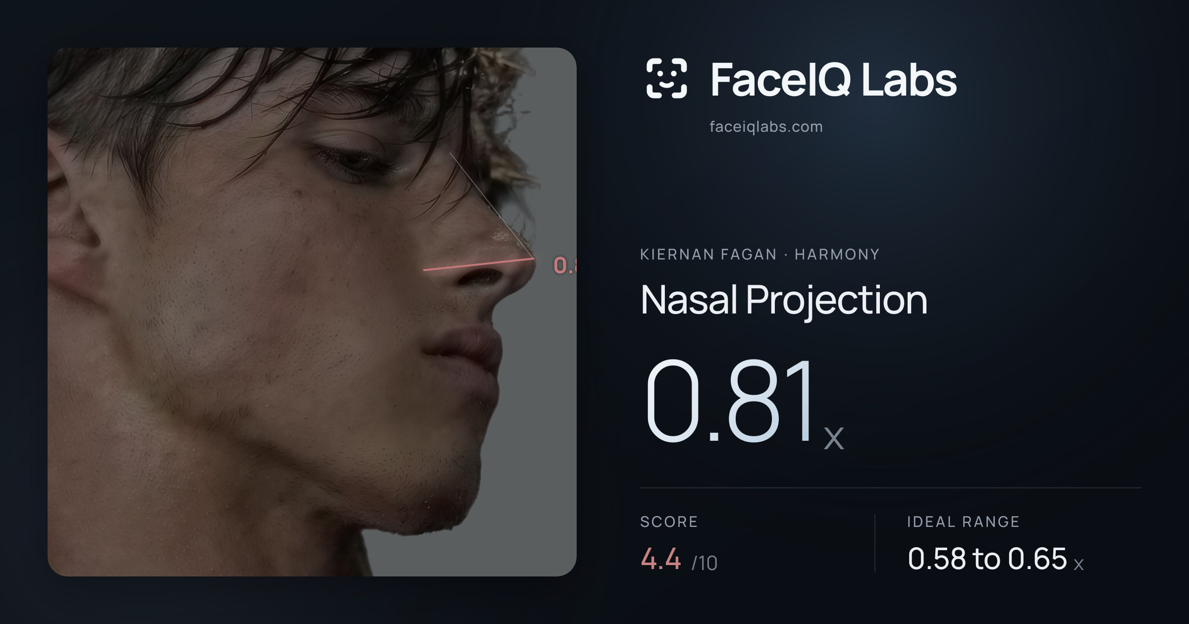 Kiernan Fagan Nasal Projection: 0.81x, drawn on the photo
