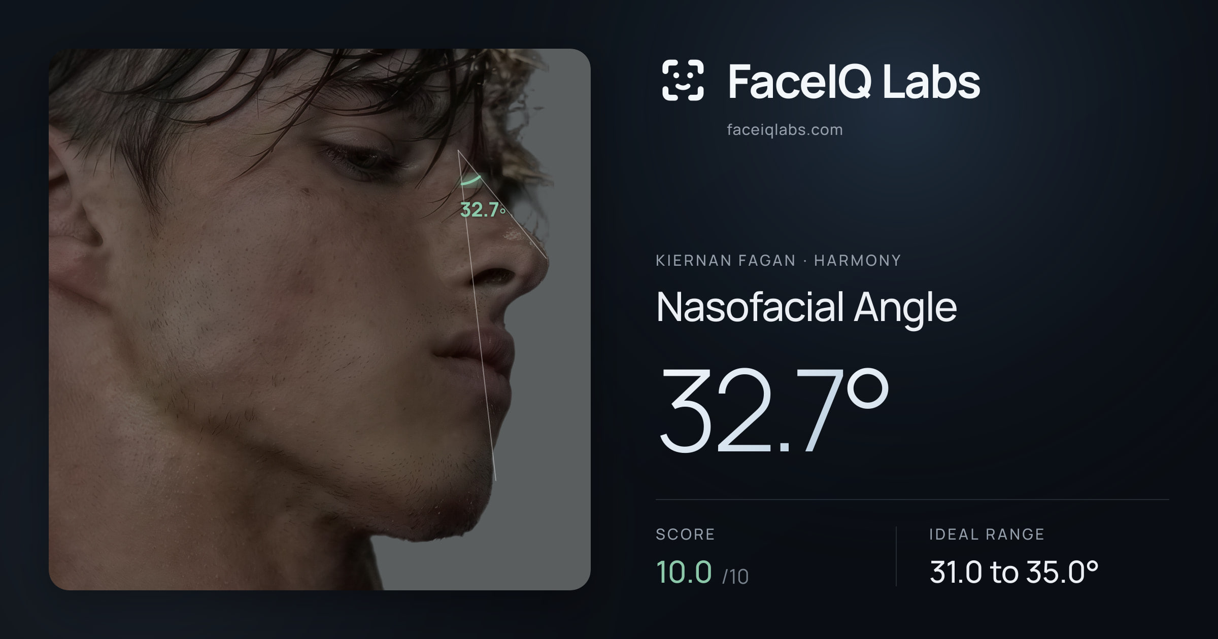 Kiernan Fagan Nasofacial Angle: 32.7°, drawn on the photo