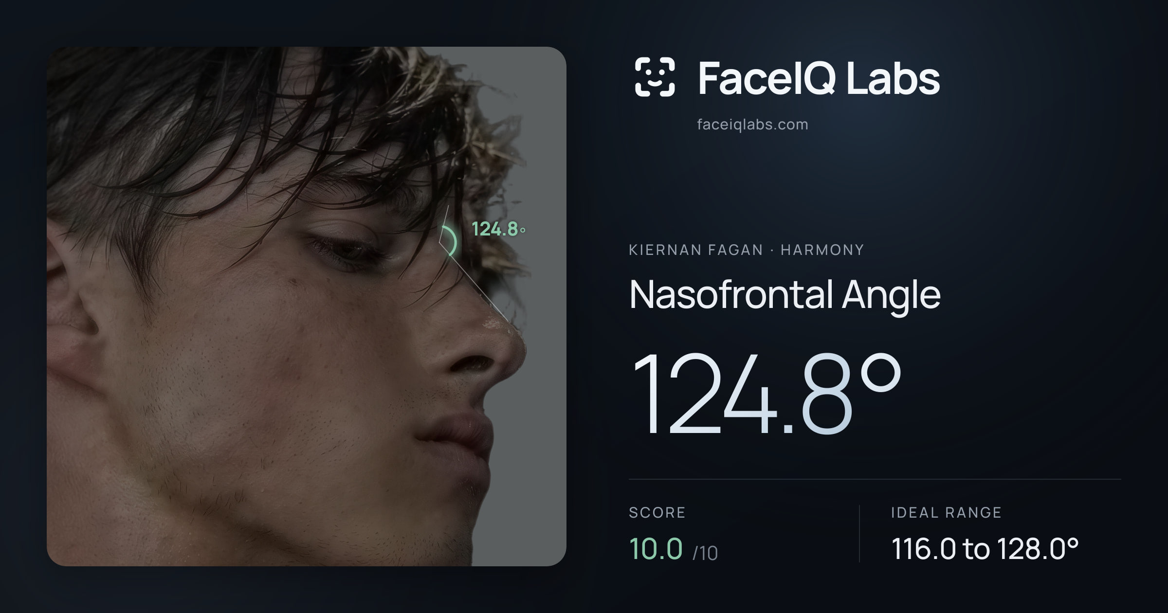 Kiernan Fagan Nasofrontal Angle: 124.8°, drawn on the photo