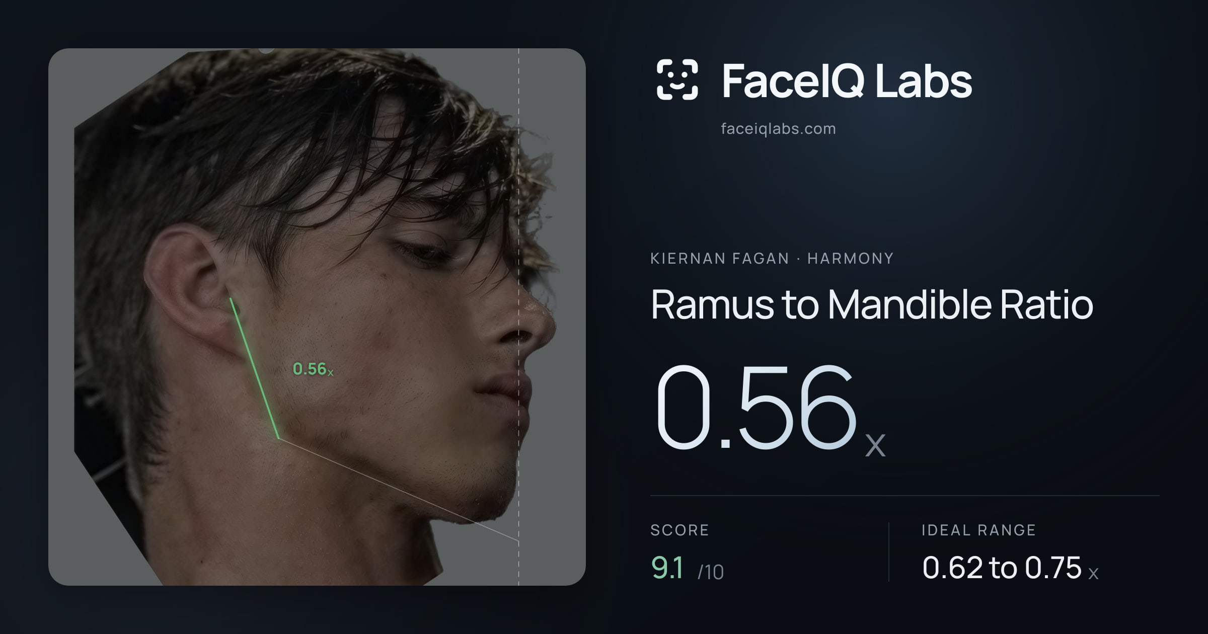 Kiernan Fagan Ramus to Mandible Ratio: 0.56x, drawn on the photo
