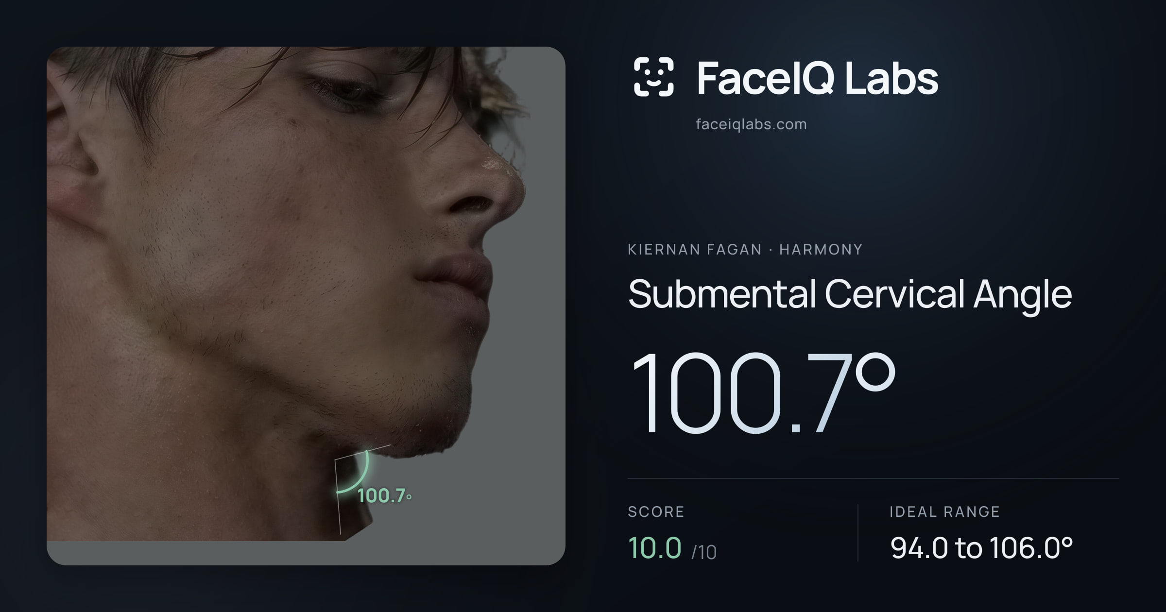 Kiernan Fagan Submental Cervical Angle: 100.7°, drawn on the photo