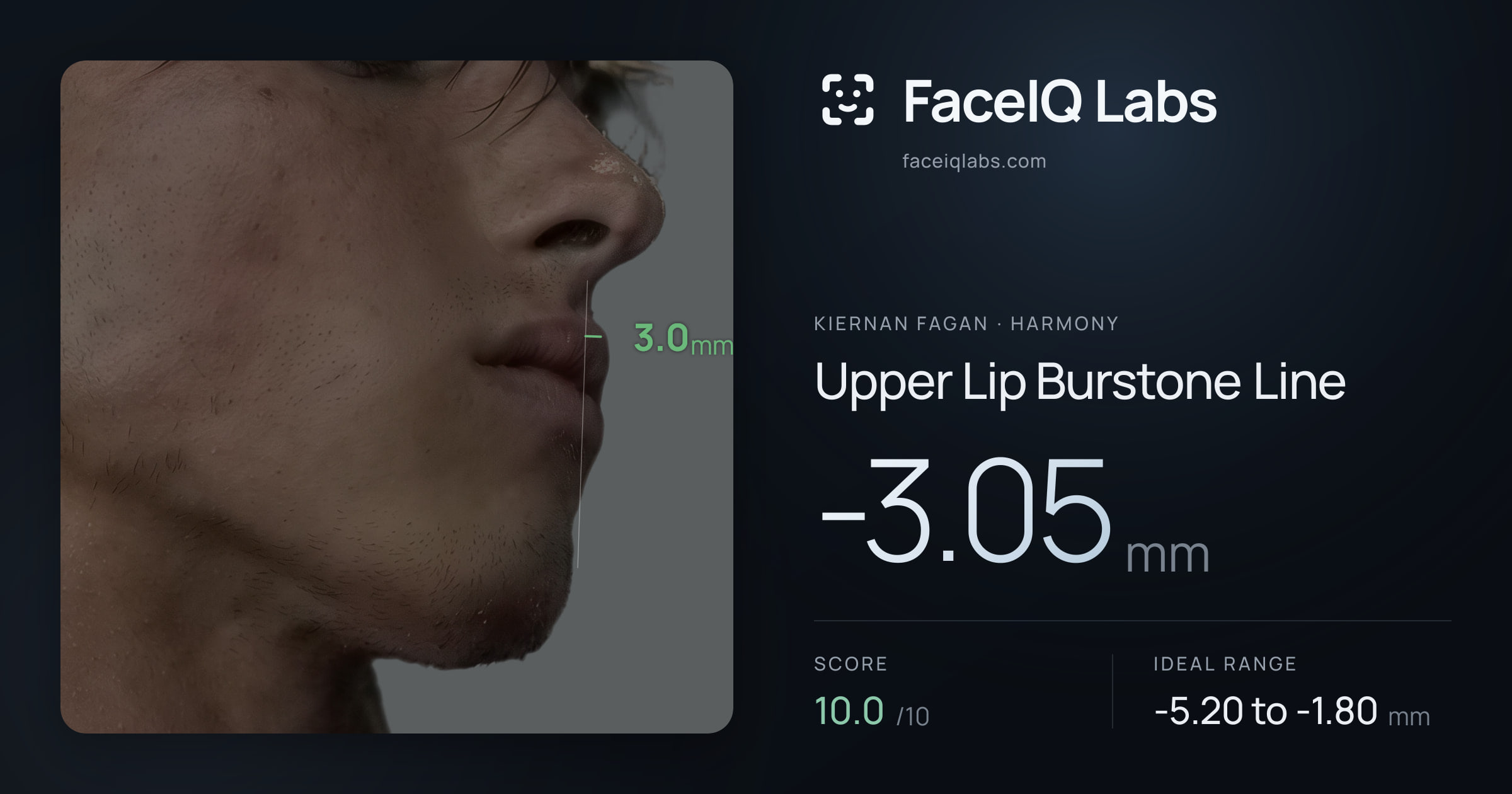 Kiernan Fagan Upper Lip Burstone Line: -3.05mm, drawn on the photo