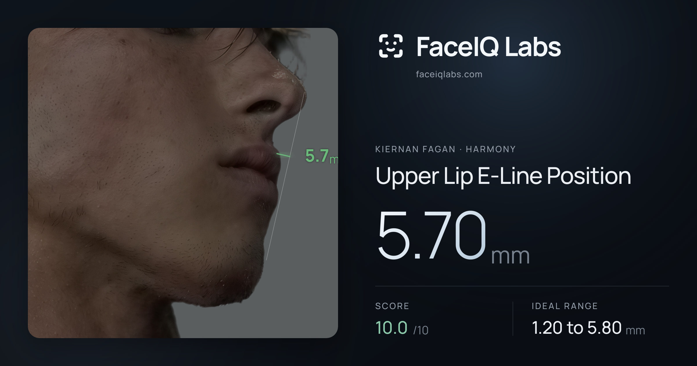 Kiernan Fagan Upper Lip E-Line Position: 5.70mm, drawn on the photo