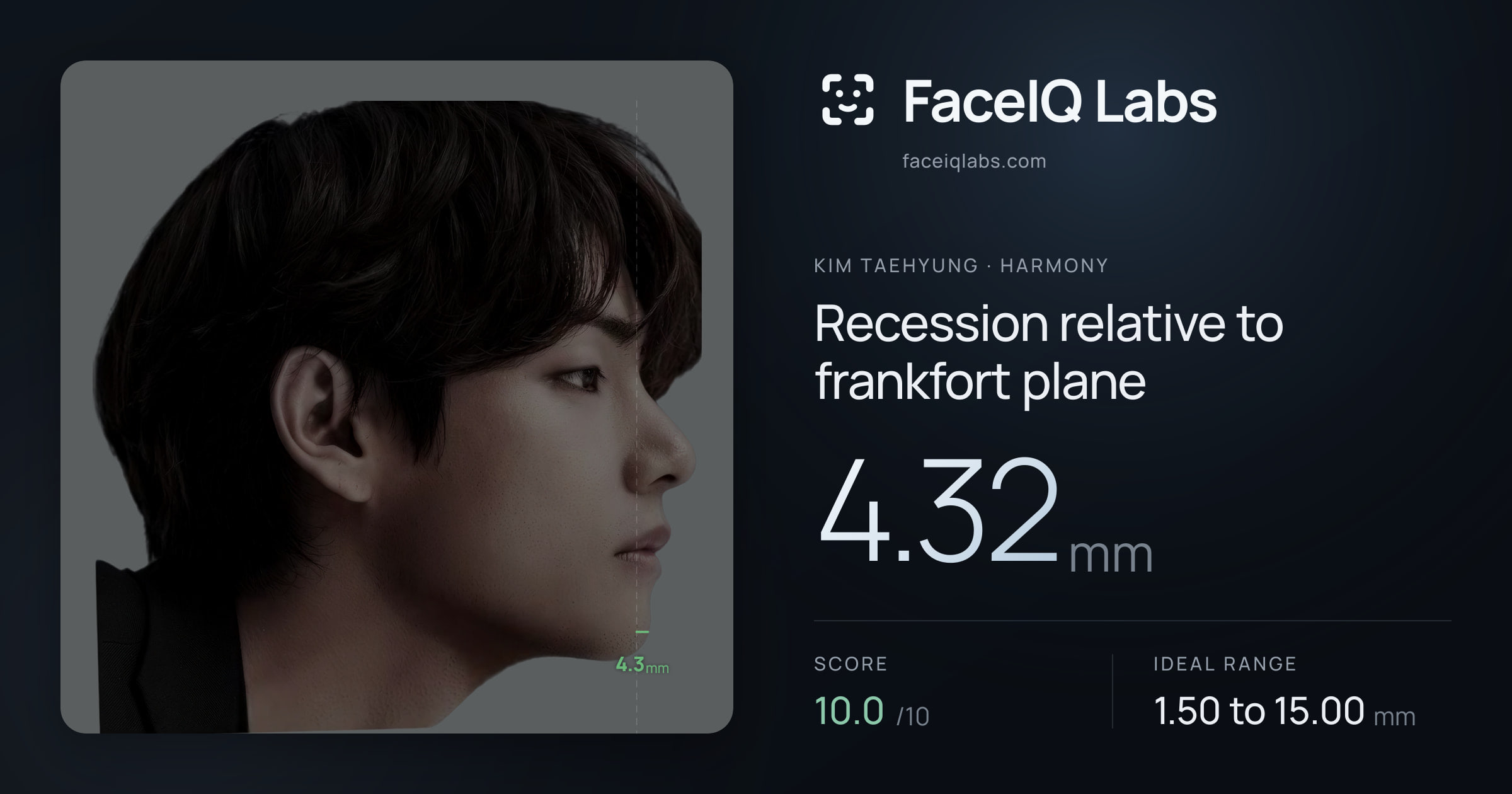 Kim Taehyung Recession relative to frankfort plane: 4.32mm, drawn on the photo
