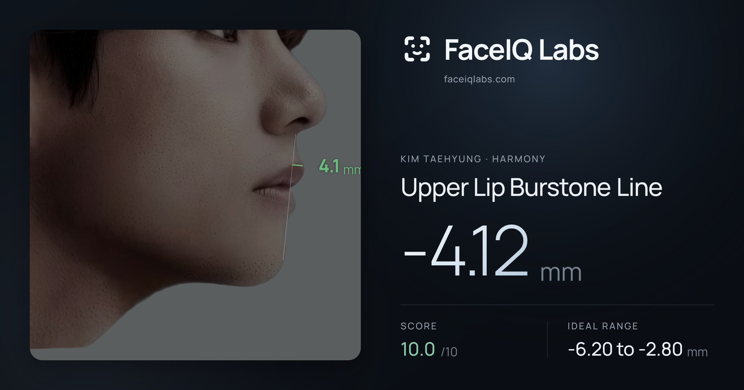 Kim Taehyung Upper Lip Burstone Line: -4.12mm, drawn on the photo
