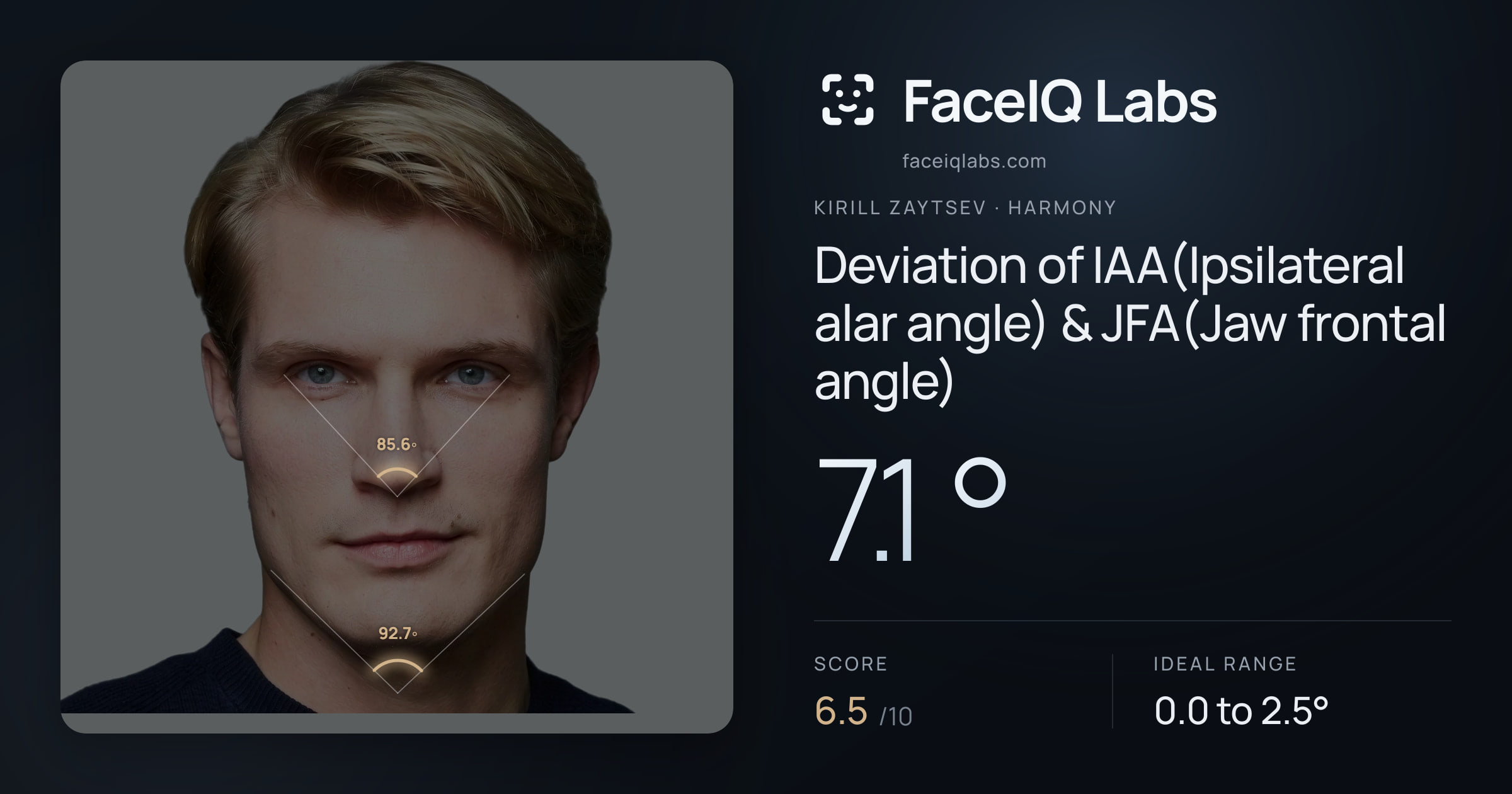 Kirill Zaytsev Deviation of IAA(Ipsilateral alar angle) & JFA(Jaw frontal angle): 7.1°, drawn on the photo