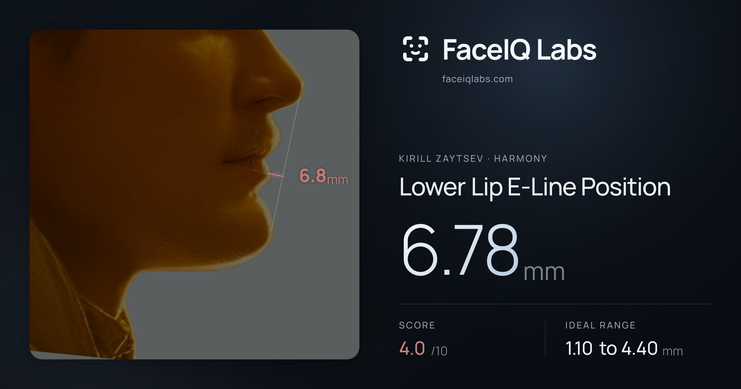 Kirill Zaytsev Lower Lip E-Line Position: 6.78mm, drawn on the photo