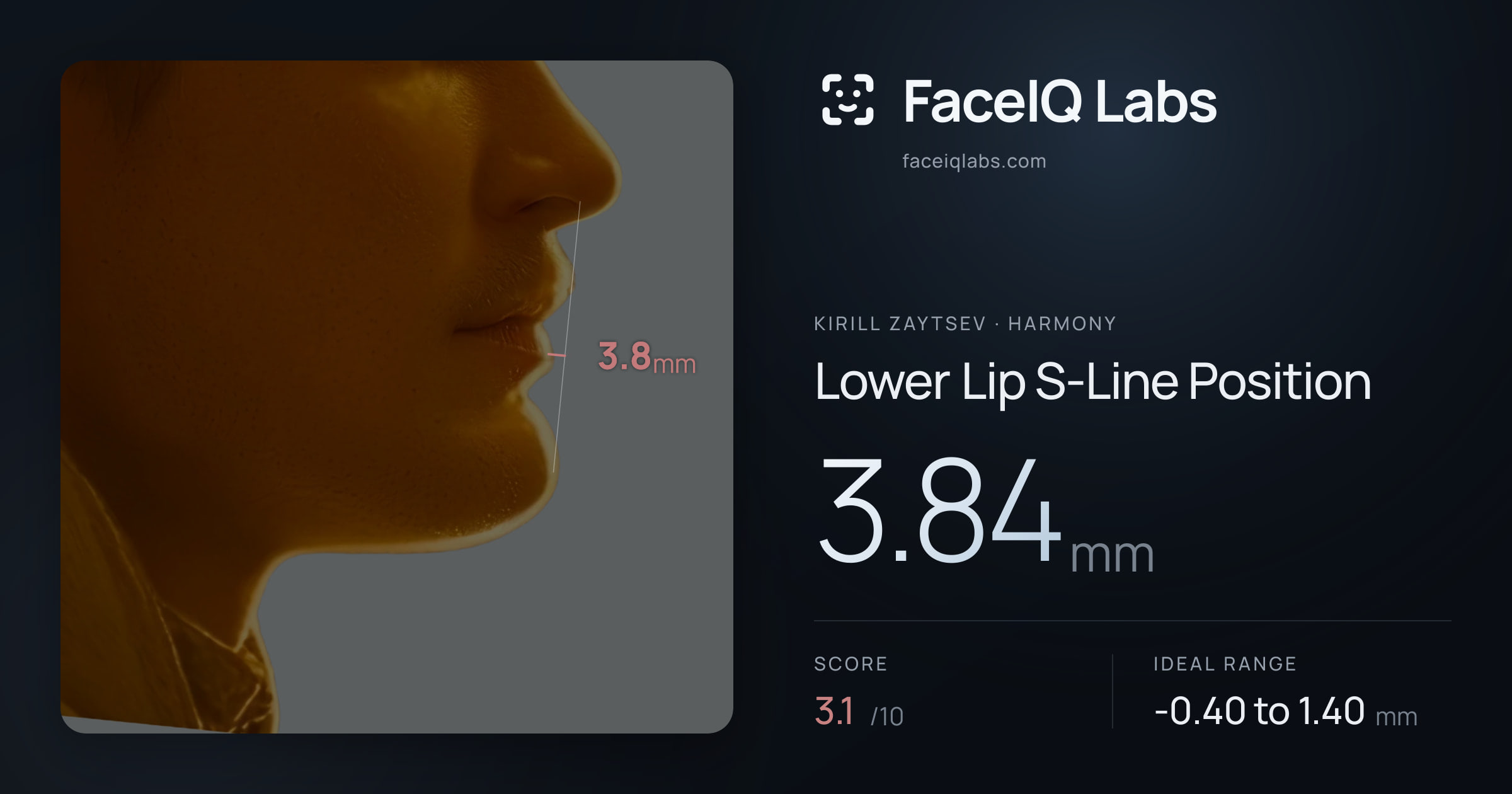 Kirill Zaytsev Lower Lip S-Line Position: 3.84mm, drawn on the photo