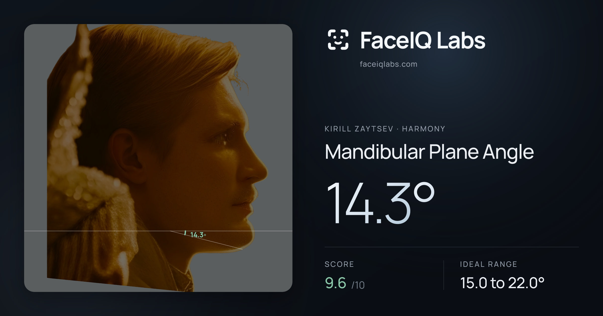 Kirill Zaytsev Mandibular Plane Angle: 14.3°, drawn on the photo
