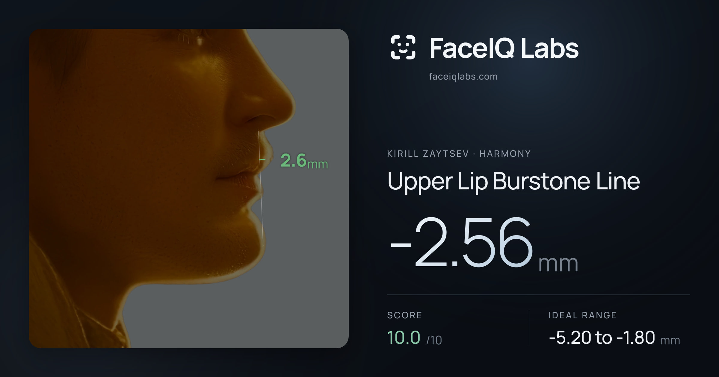 Kirill Zaytsev Upper Lip Burstone Line: -2.56mm, drawn on the photo