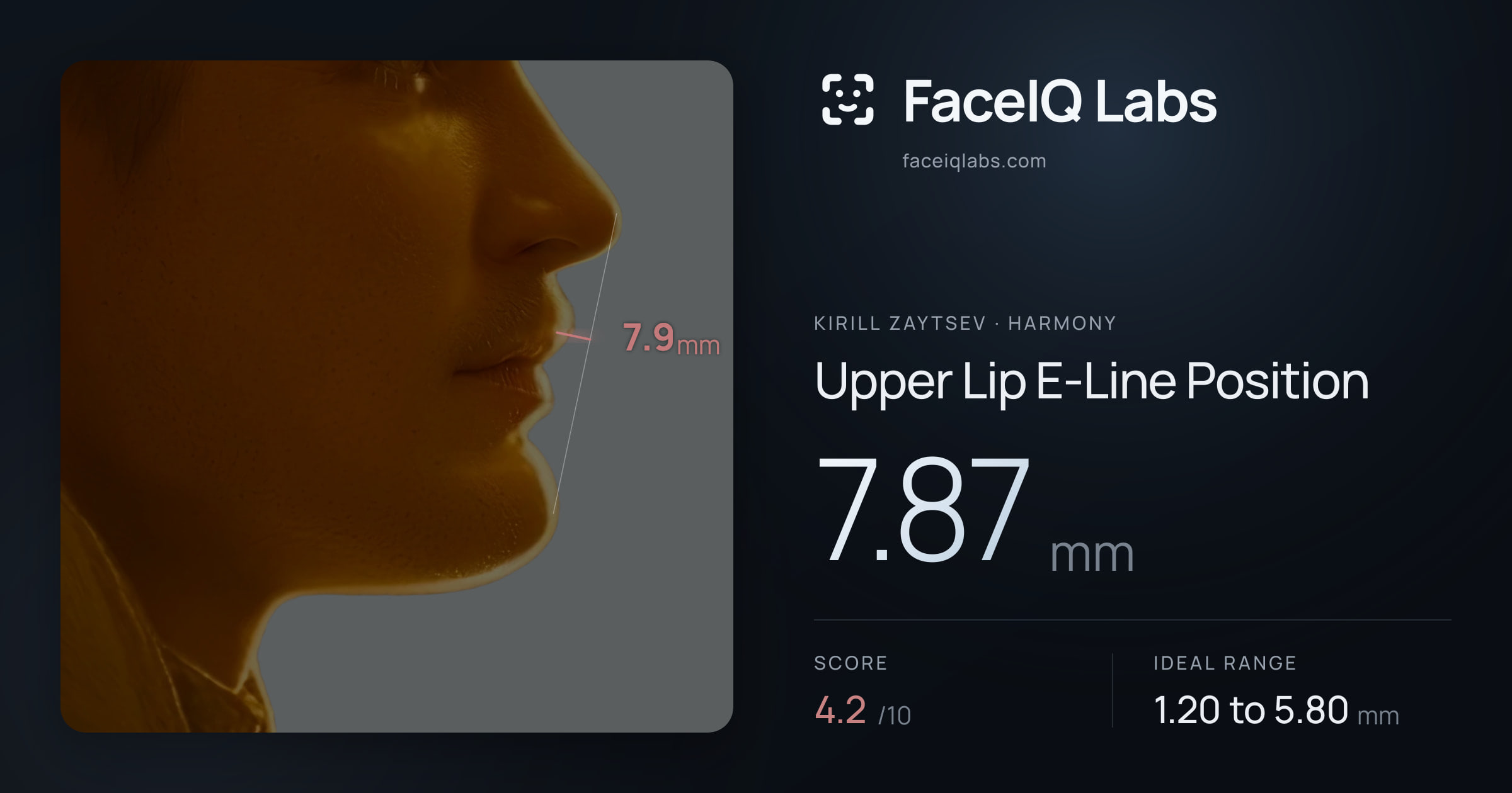 Kirill Zaytsev Upper Lip E-Line Position: 7.87mm, drawn on the photo