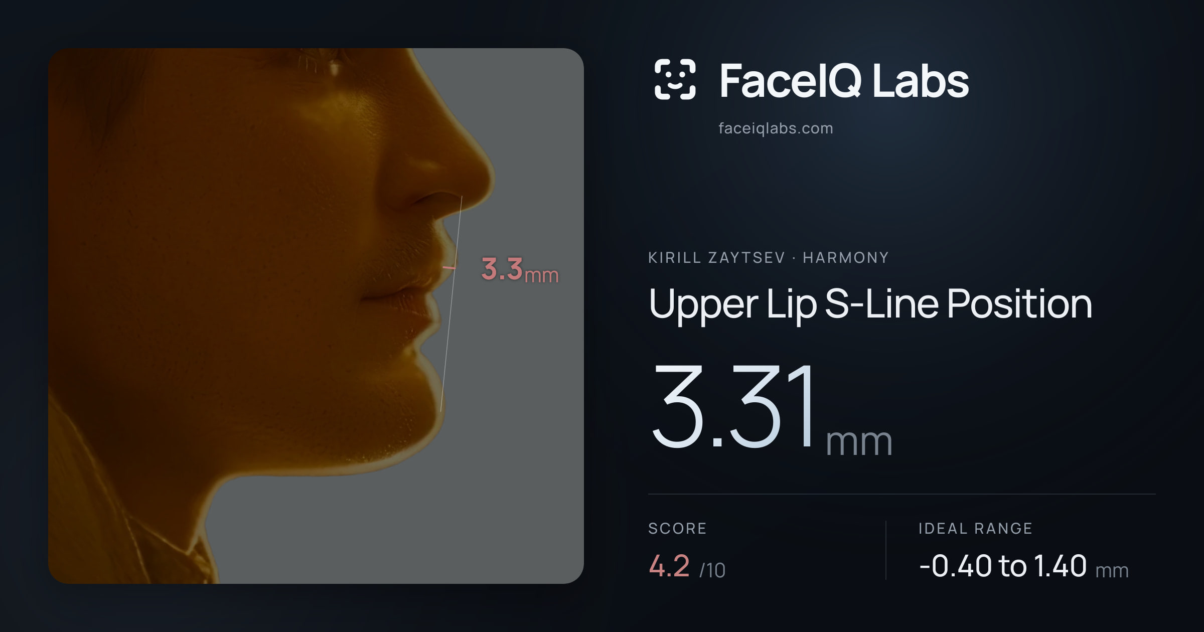 Kirill Zaytsev Upper Lip S-Line Position: 3.31mm, drawn on the photo
