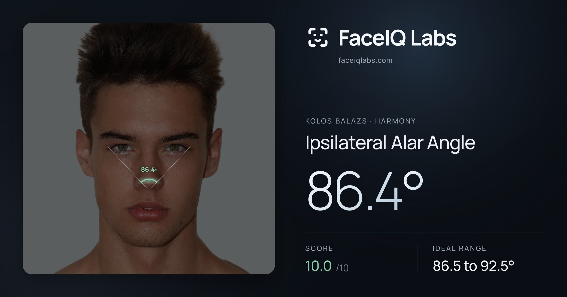 Kolos Balazs Ipsilateral Alar Angle: 86.4°, drawn on the photo