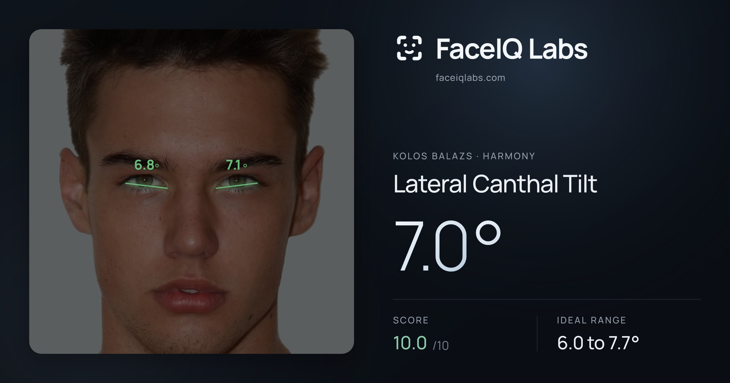 Kolos Balazs Lateral Canthal Tilt: 7.0°, drawn on the photo
