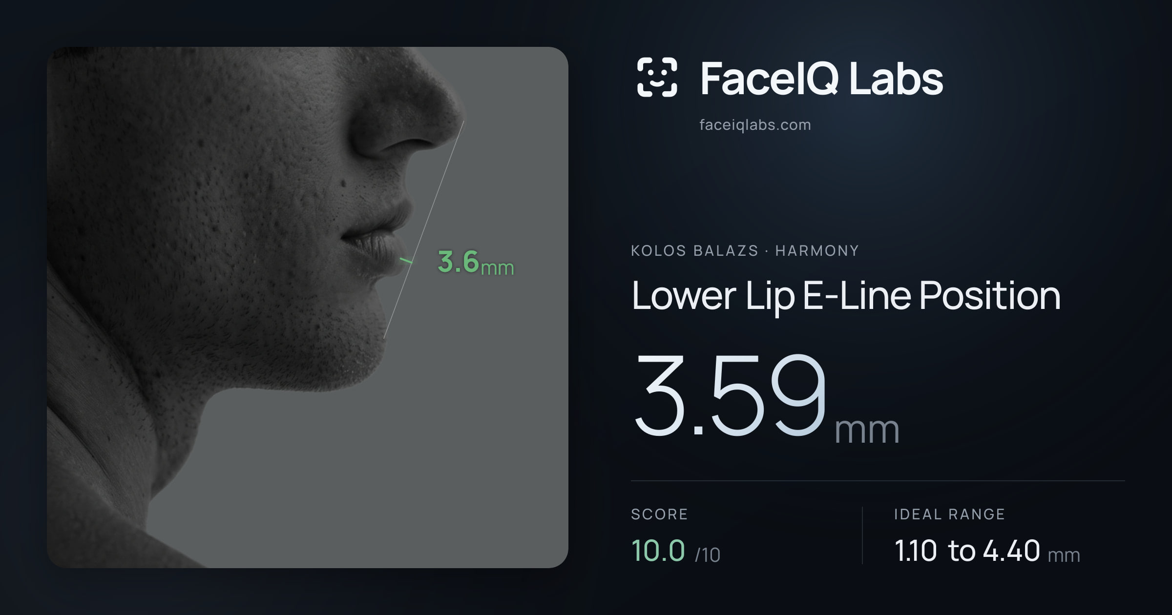 Kolos Balazs Lower Lip E-Line Position: 3.59mm, drawn on the photo