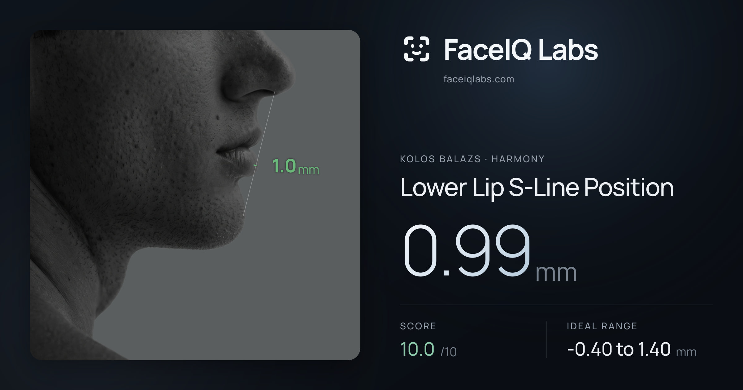 Kolos Balazs Lower Lip S-Line Position: 0.99mm, drawn on the photo