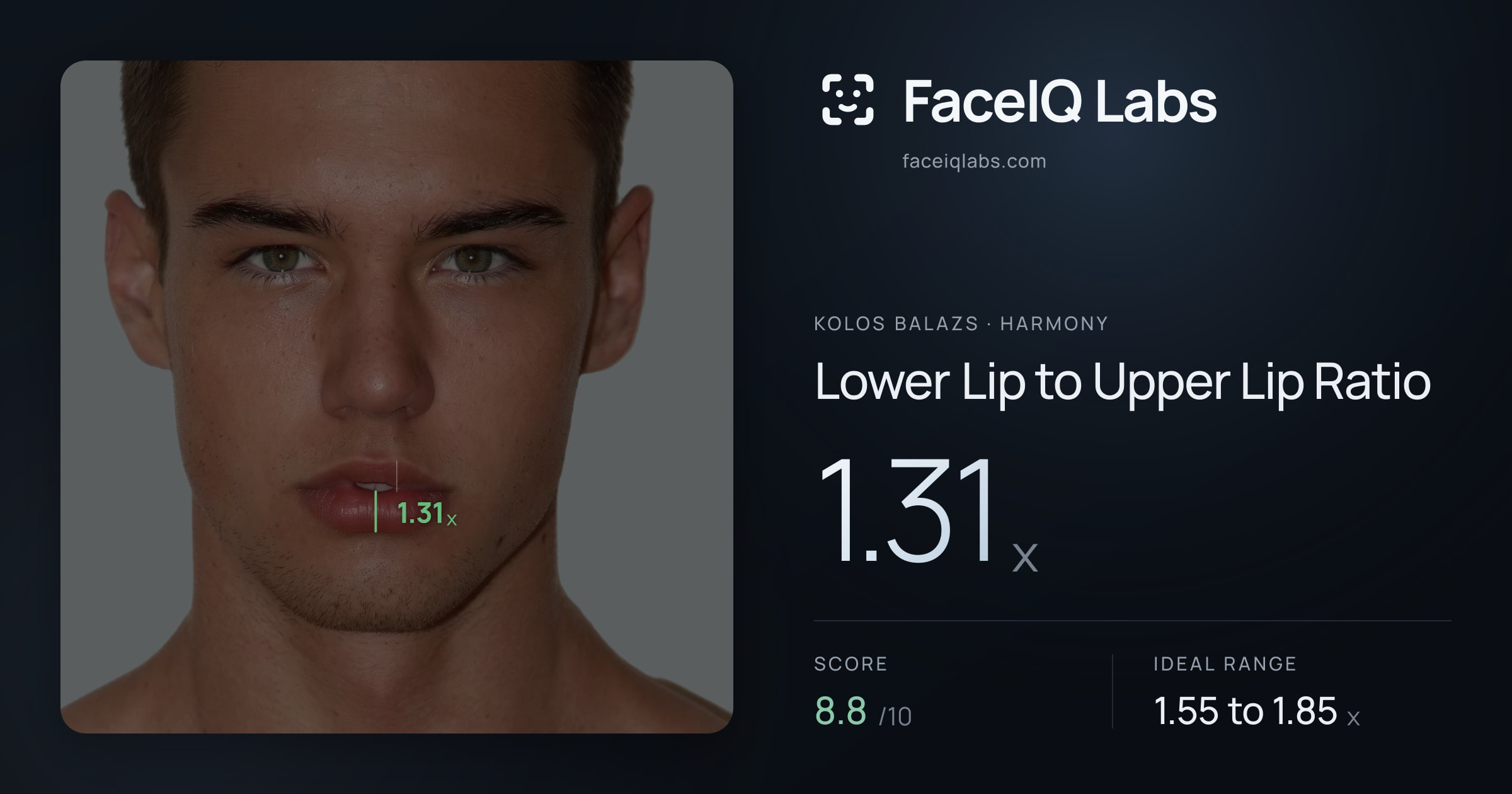 Kolos Balazs Lower Lip to Upper Lip Ratio: 1.31x, drawn on the photo