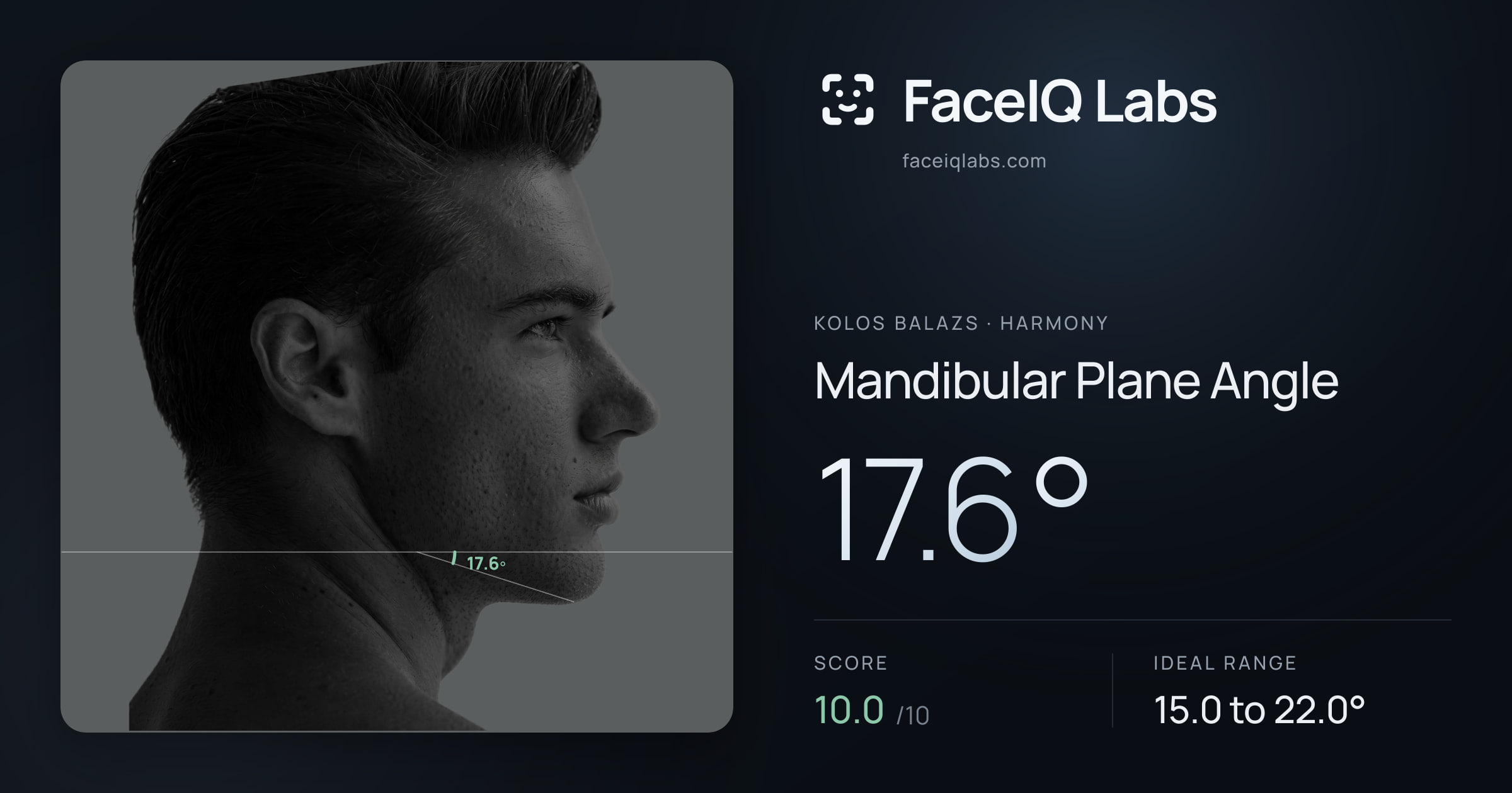 Kolos Balazs Mandibular Plane Angle: 17.6°, drawn on the photo