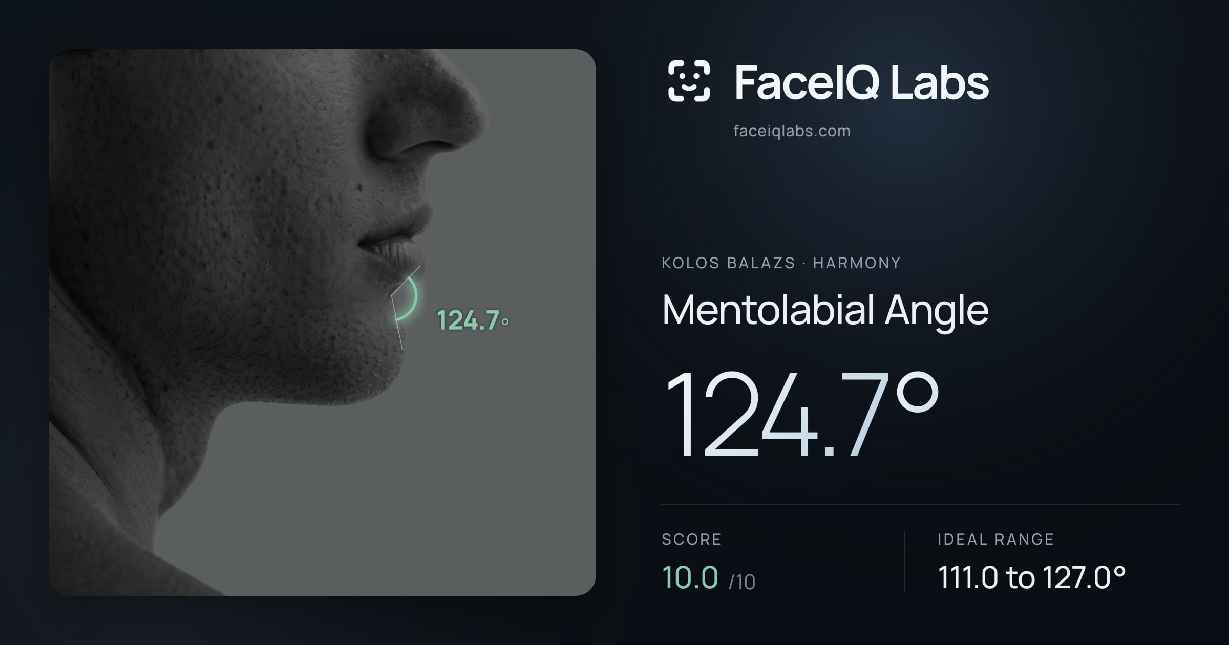 Kolos Balazs Mentolabial Angle: 124.7°, drawn on the photo