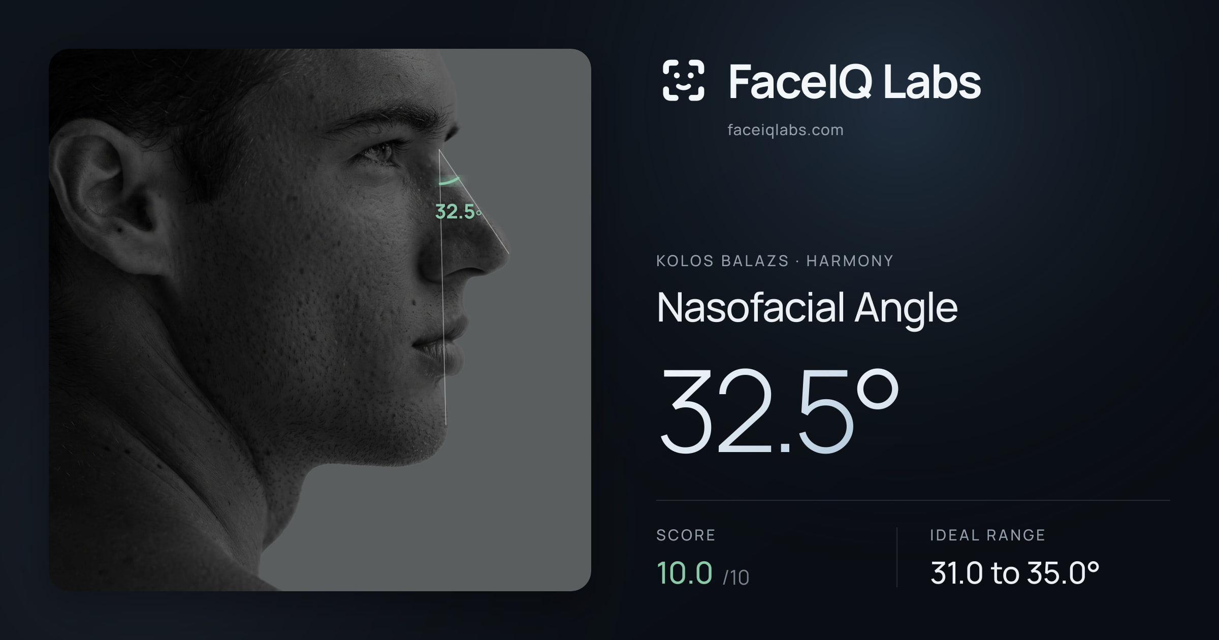 Kolos Balazs Nasofacial Angle: 32.5°, drawn on the photo