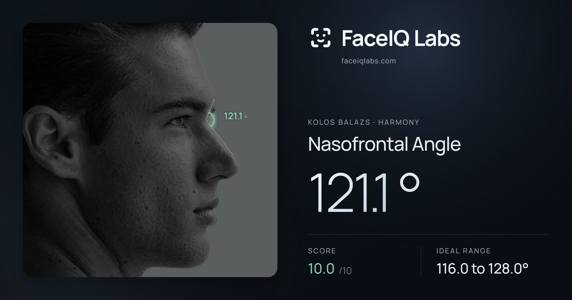 Kolos Balazs Nasofrontal Angle: 121.1°, drawn on the photo