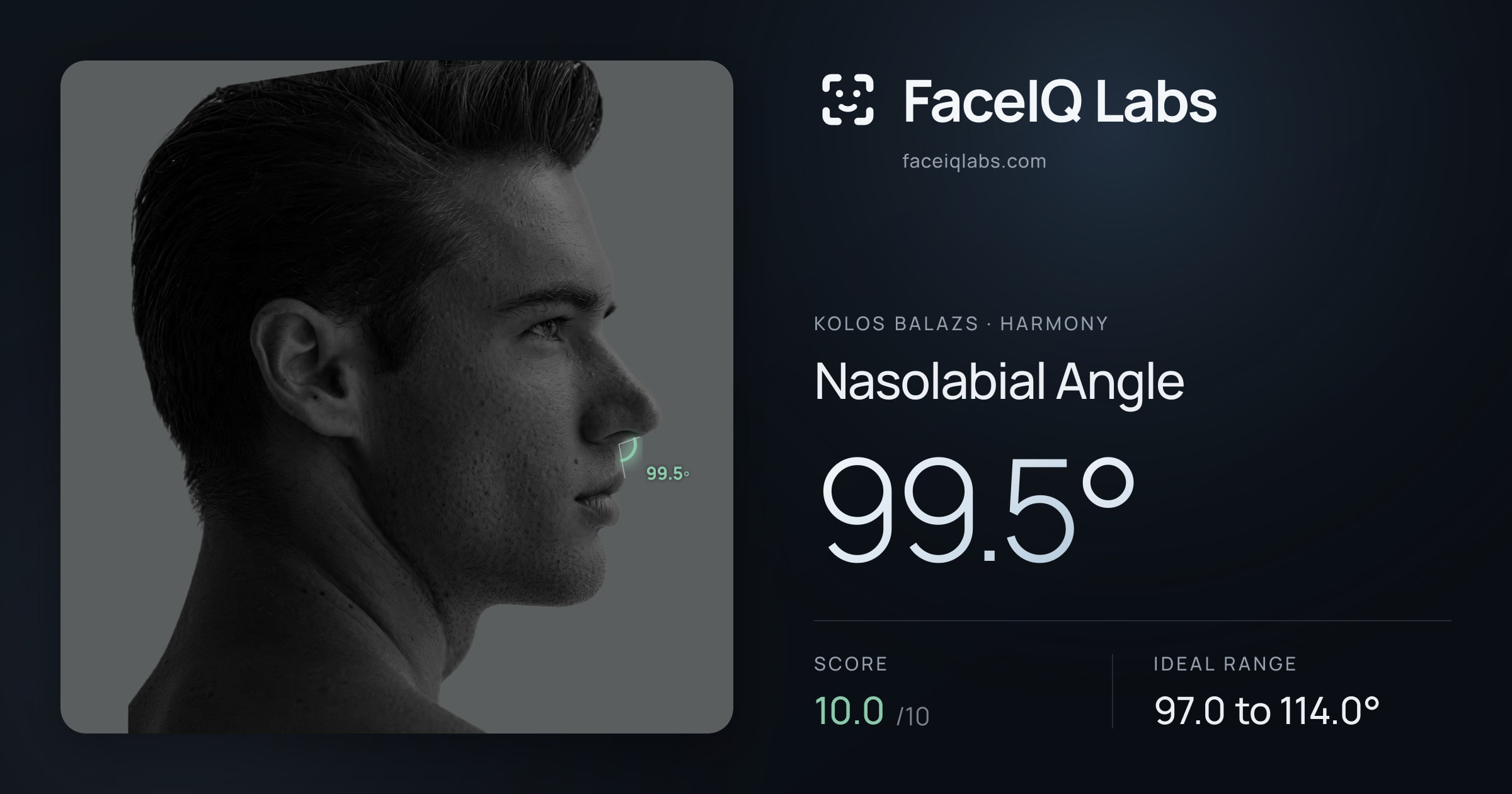 Kolos Balazs Nasolabial Angle: 99.5°, drawn on the photo