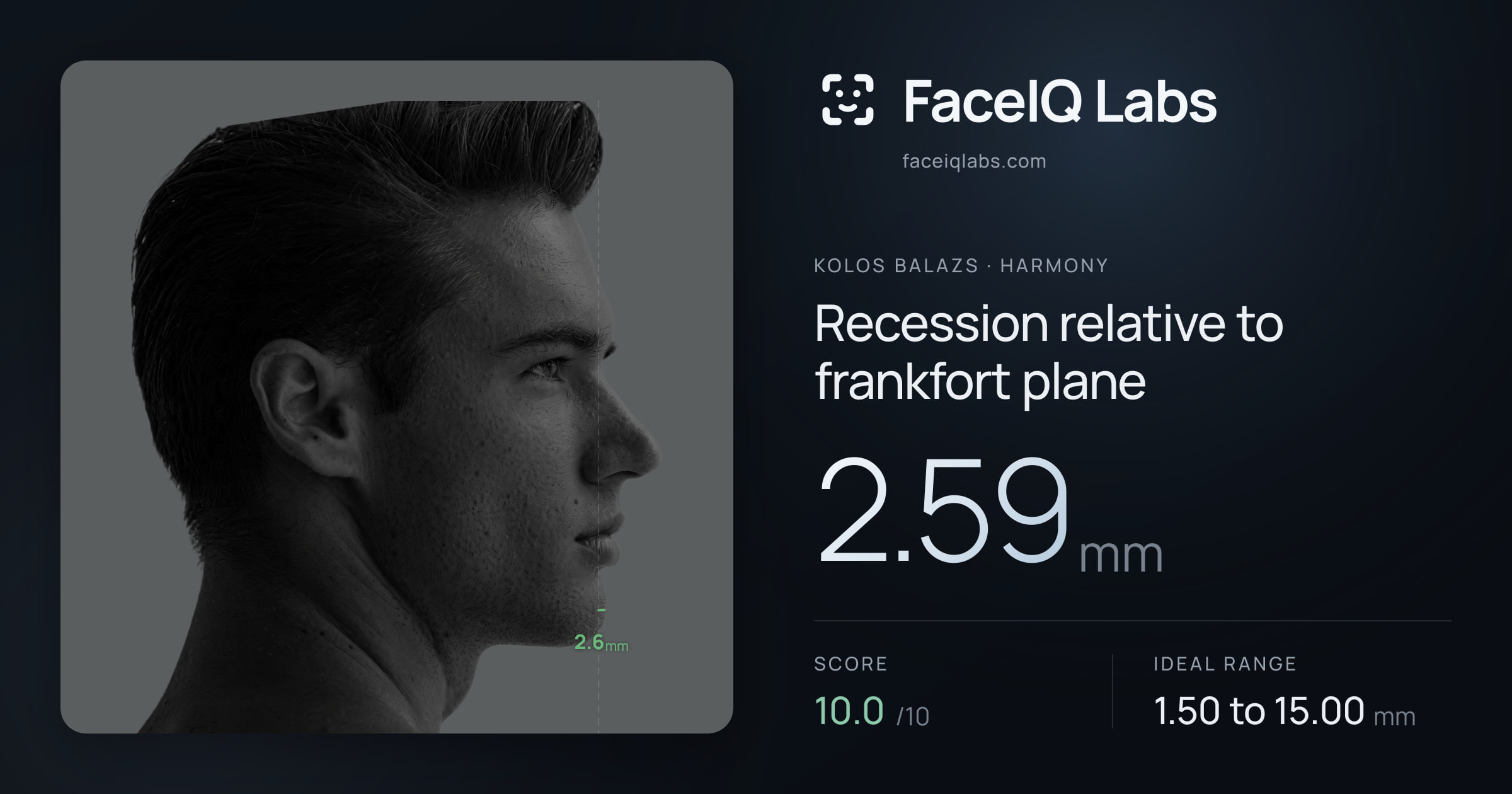 Kolos Balazs Recession relative to frankfort plane: 2.59mm, drawn on the photo