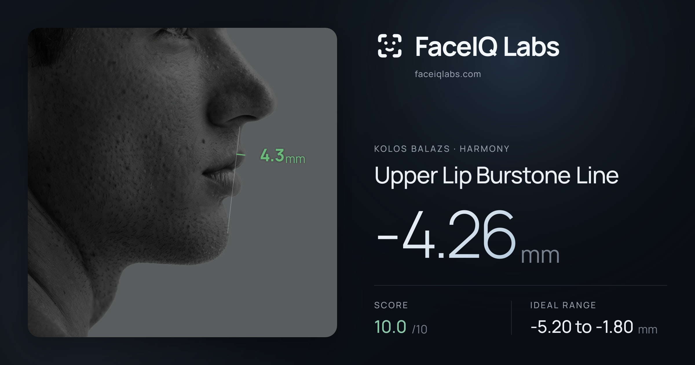 Kolos Balazs Upper Lip Burstone Line: -4.26mm, drawn on the photo