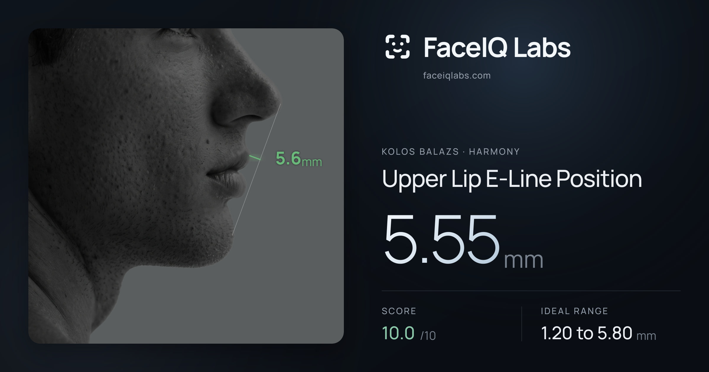 Kolos Balazs Upper Lip E-Line Position: 5.55mm, drawn on the photo