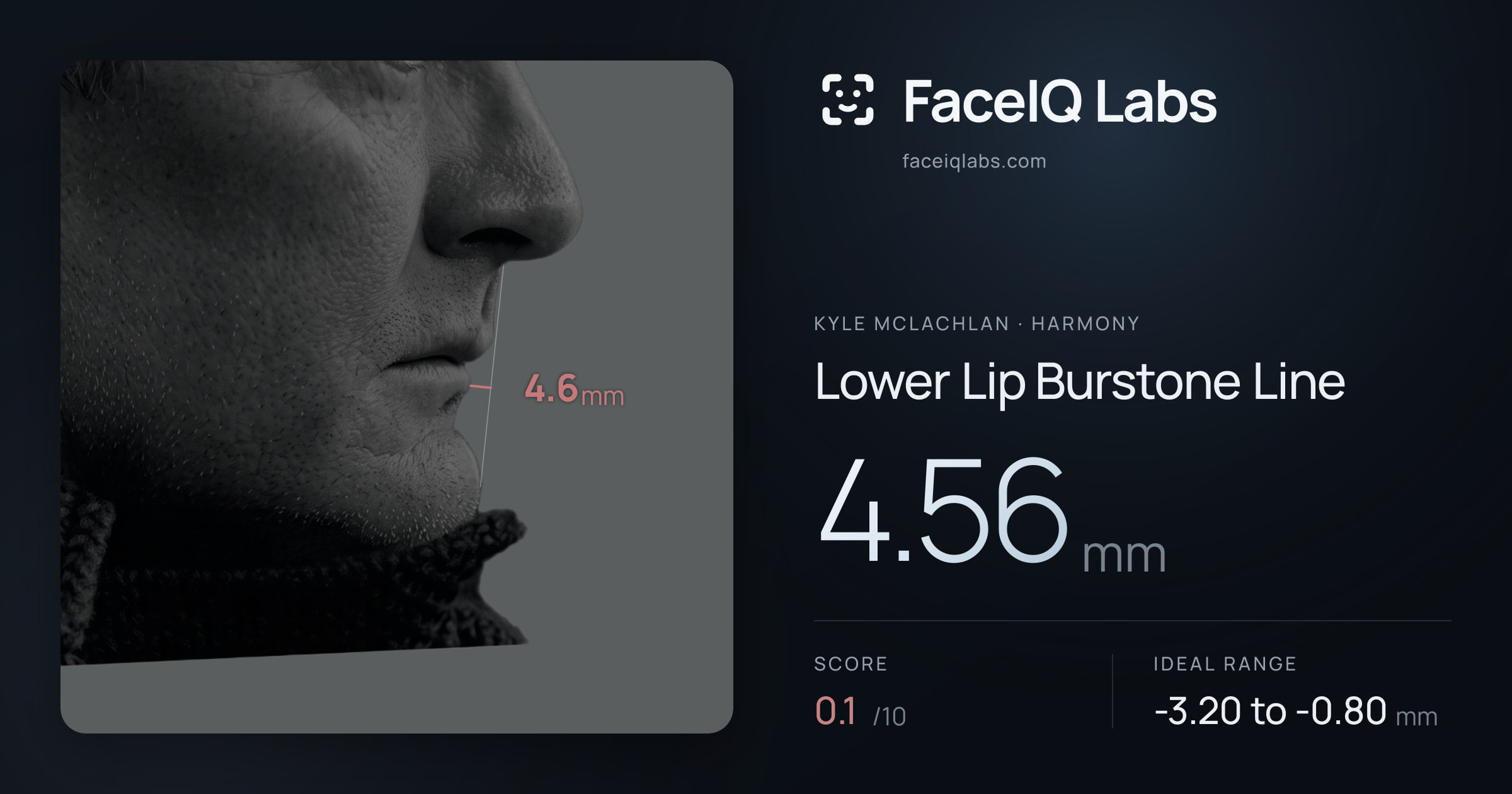 Kyle McLachlan Lower Lip Burstone Line: 4.56mm, drawn on the photo