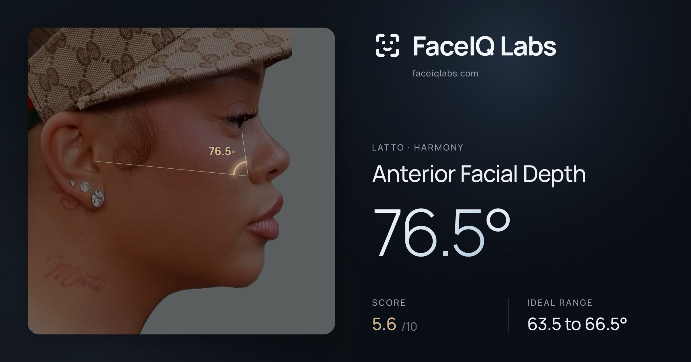 Latto Anterior Facial Depth: 76.5°, drawn on the photo