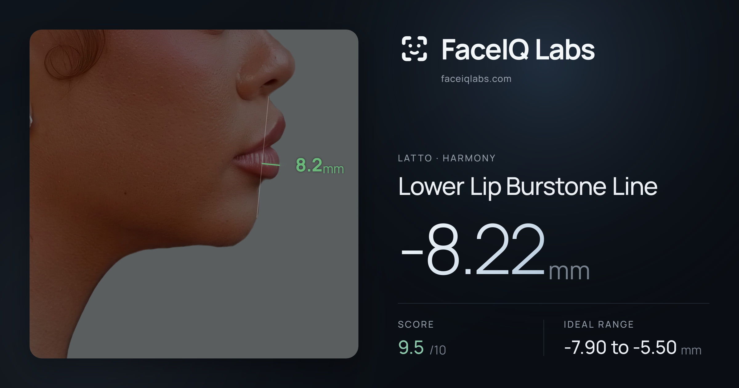 Latto Lower Lip Burstone Line: -8.22mm, drawn on the photo