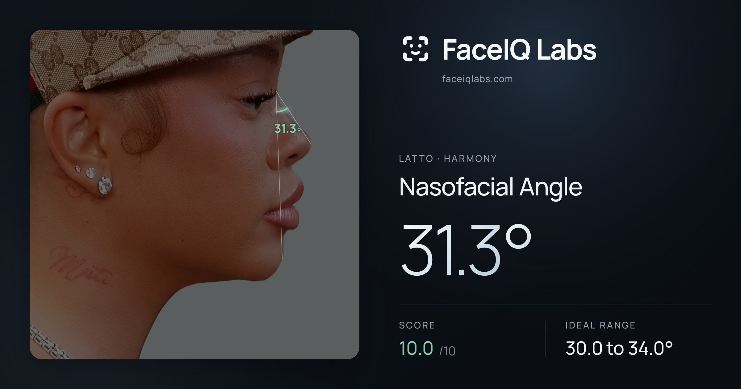 Latto Nasofacial Angle: 31.3°, drawn on the photo