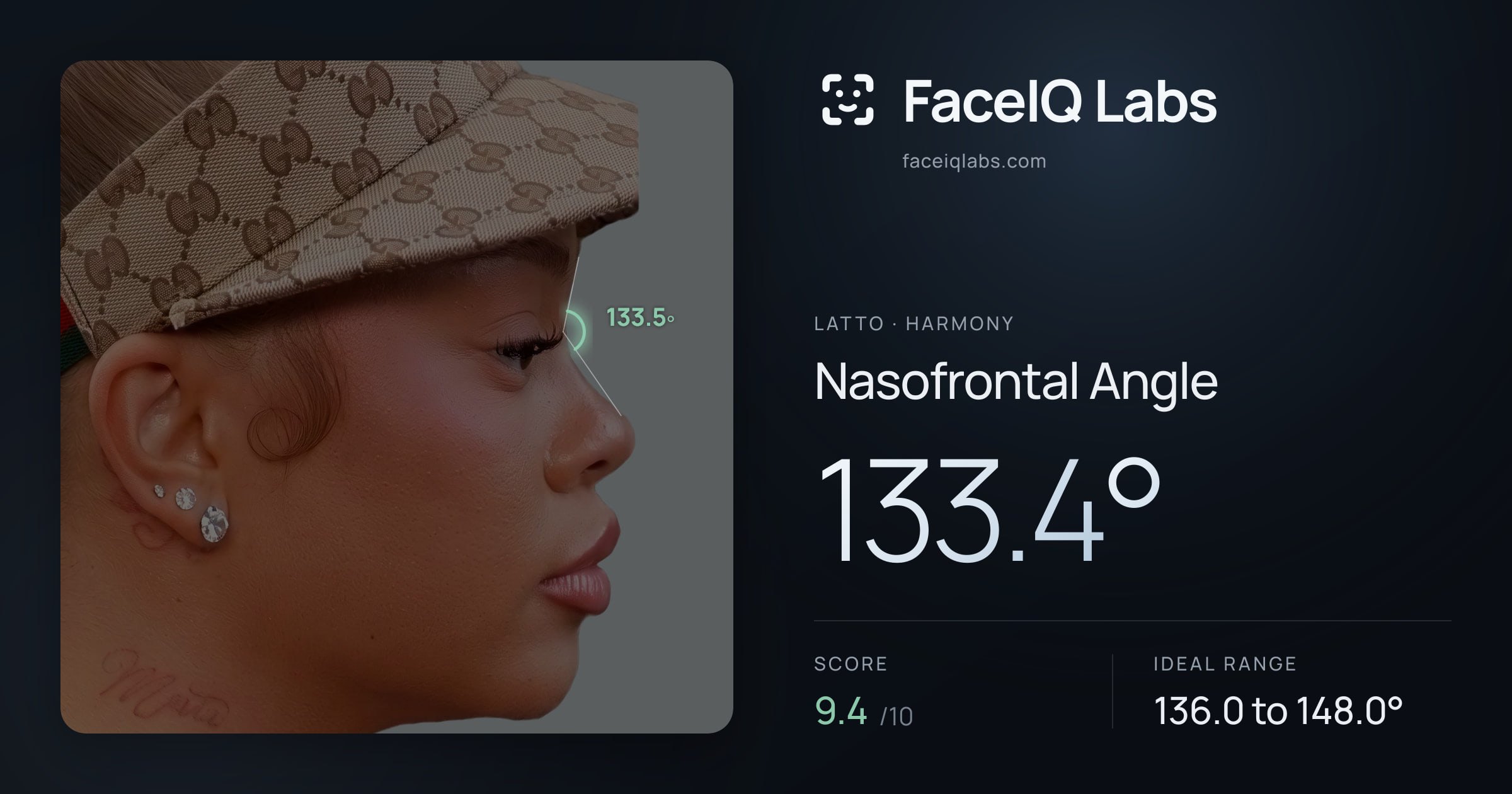 Latto Nasofrontal Angle: 133.4°, drawn on the photo