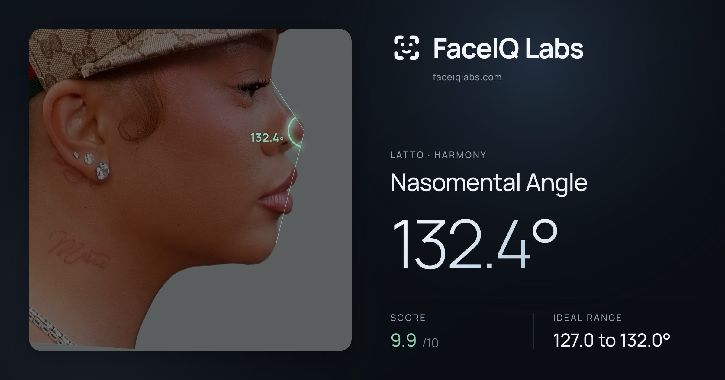 Latto Nasomental Angle: 132.4°, drawn on the photo