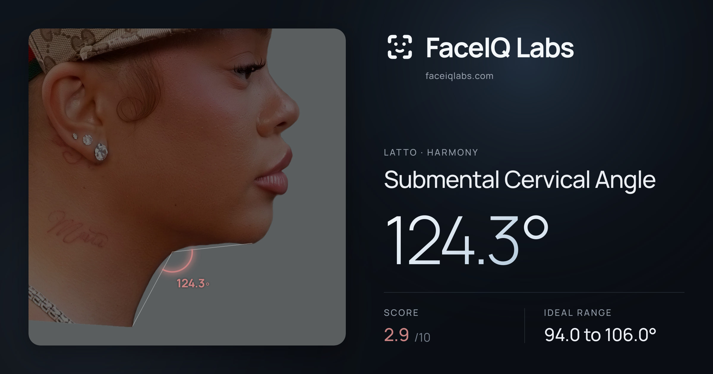 Latto Submental Cervical Angle: 124.3°, drawn on the photo