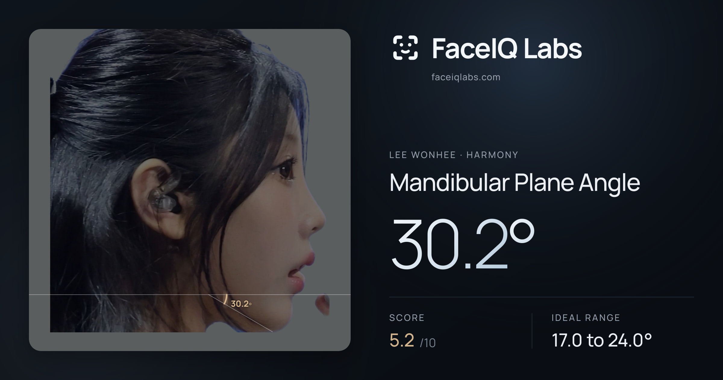 Lee Wonhee Mandibular Plane Angle: 30.2°, drawn on the photo