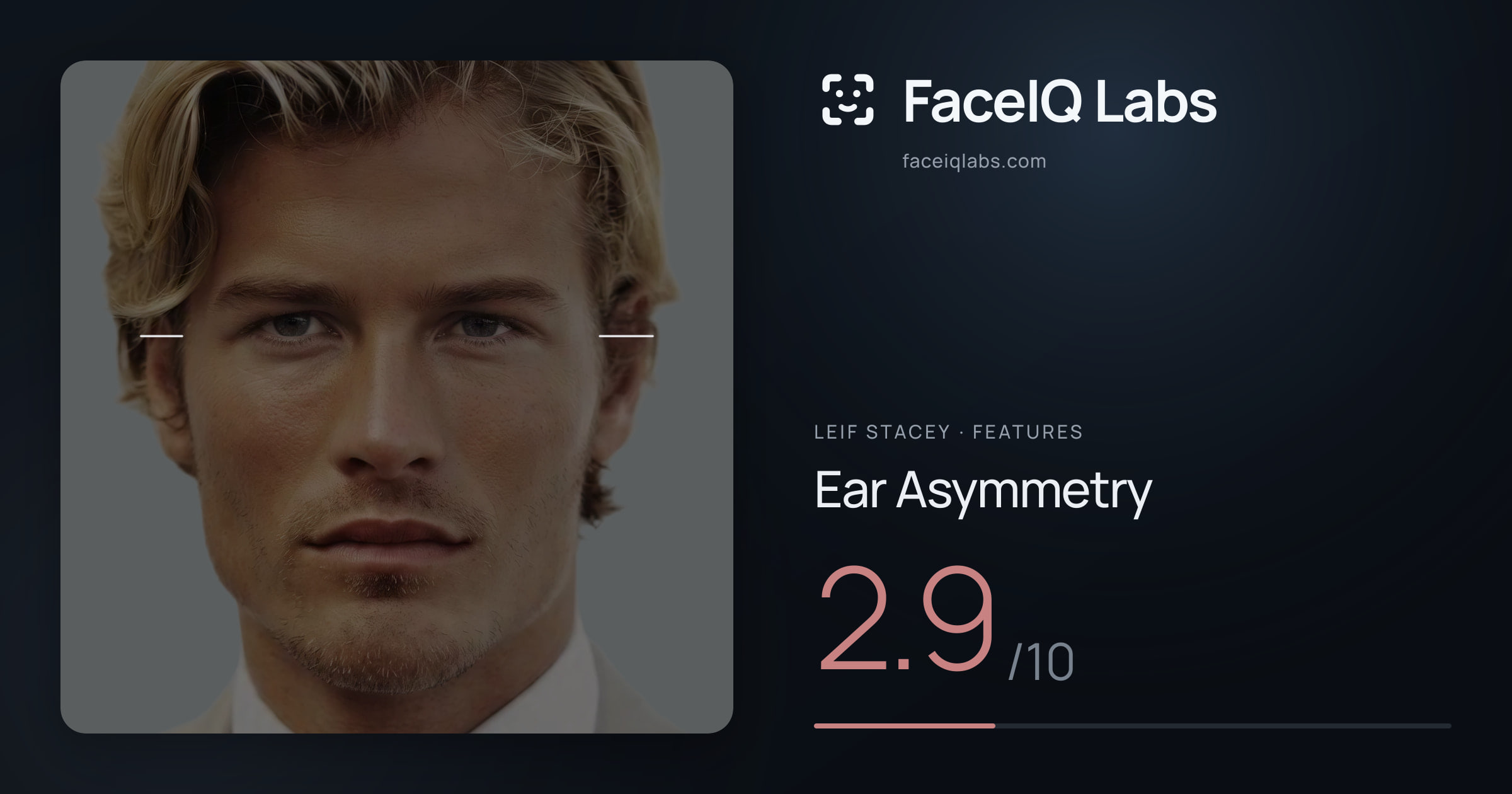 Leif Stacey Ear Asymmetry: 2.9/10, drawn on the photo