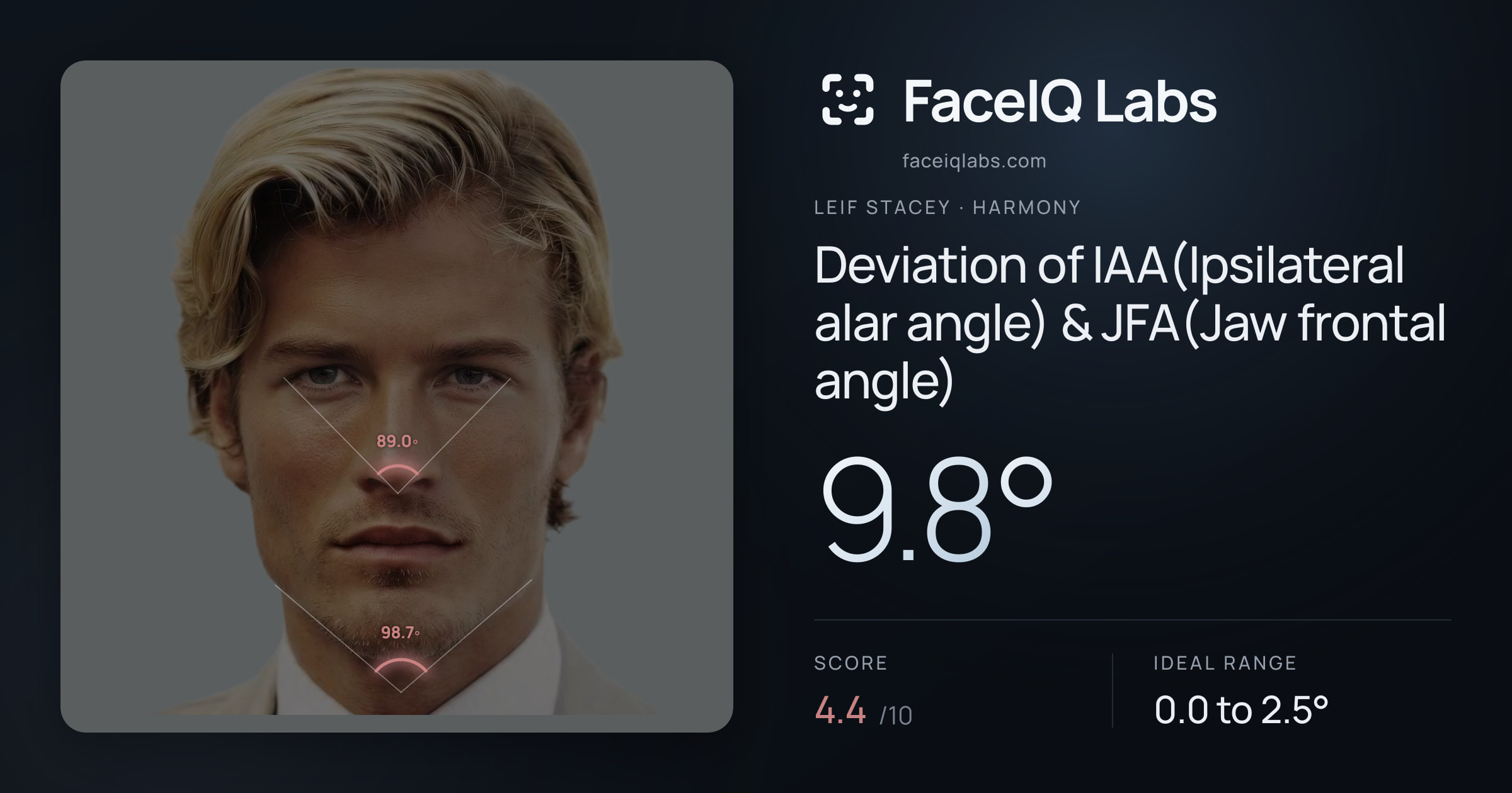 Leif Stacey Deviation of IAA(Ipsilateral alar angle) & JFA(Jaw frontal angle): 9.8°, drawn on the photo