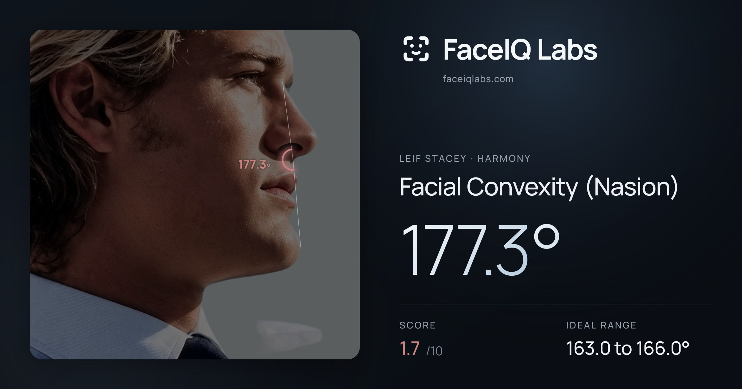 Leif Stacey Facial Convexity (Nasion): 177.3°, drawn on the photo