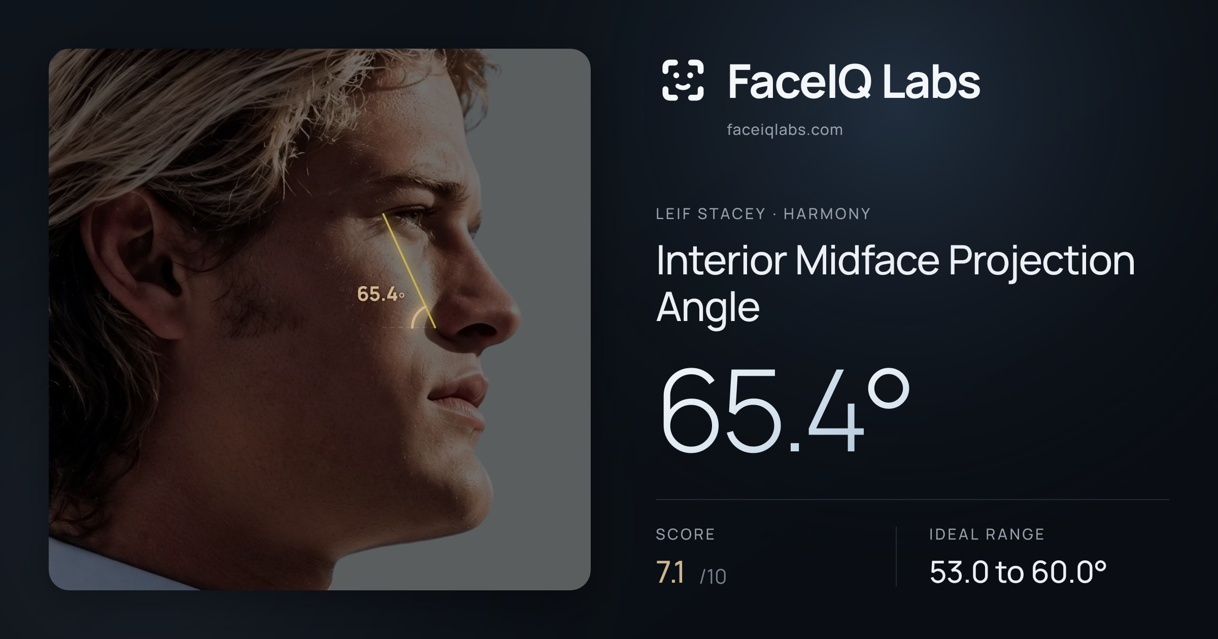 Leif Stacey Interior Midface Projection Angle: 65.4°, drawn on the photo