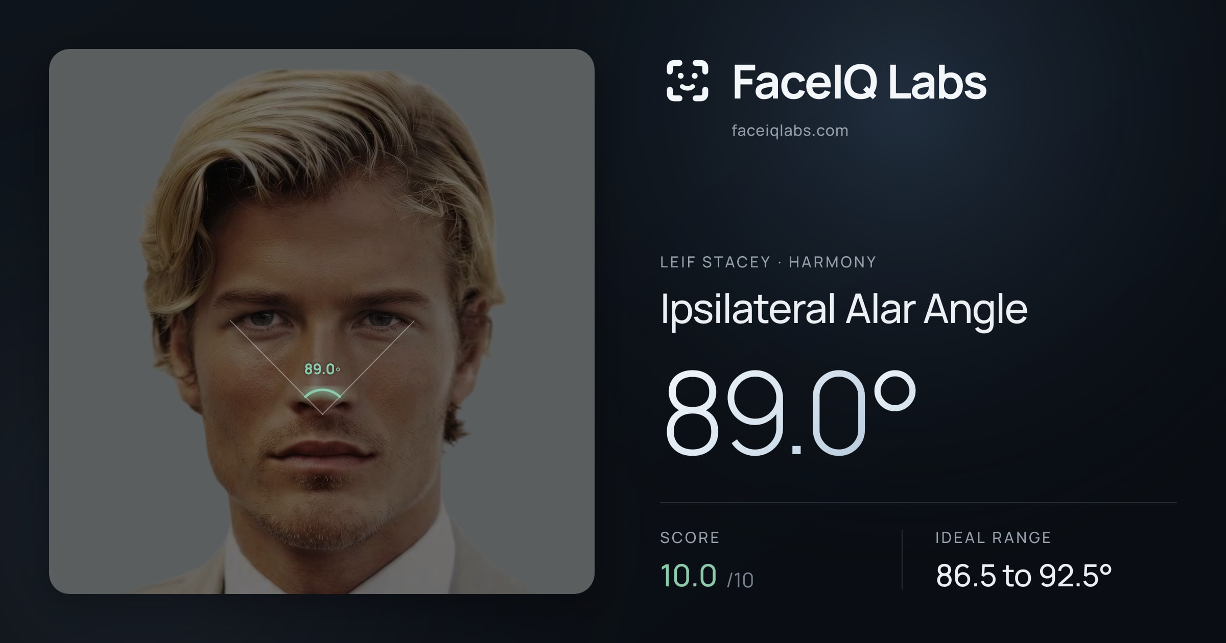 Leif Stacey Ipsilateral Alar Angle: 89.0°, drawn on the photo